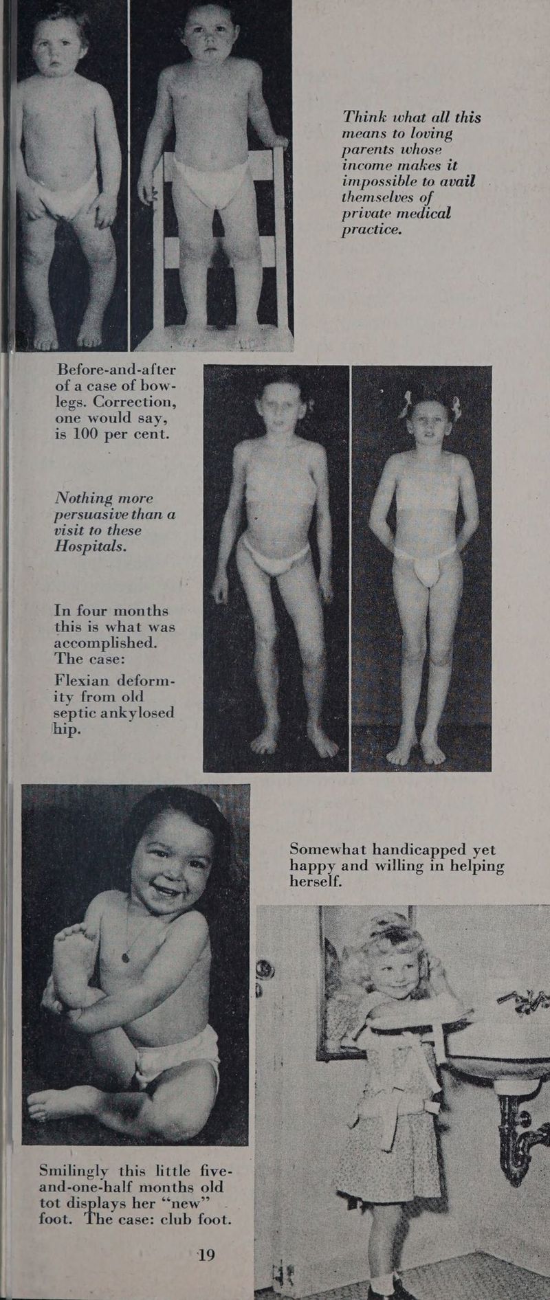 Think what all this means to loving parents whose income makes it impossible to avail themselves of private medical practice. Before-and-after of a case of bow- legs. Correction, one would say, is 100 per cent. Nothing more persuasive than a visit to these Hospitals. this is what was accomplished. | In four months The case: Flexian deform- ity from old septic ankylosed hip. Somewhat handicapped yet happy and willing in helping herself. Smilingly this little five- : and-one-half months old tot displays her “new” | foot. The case: club foot.