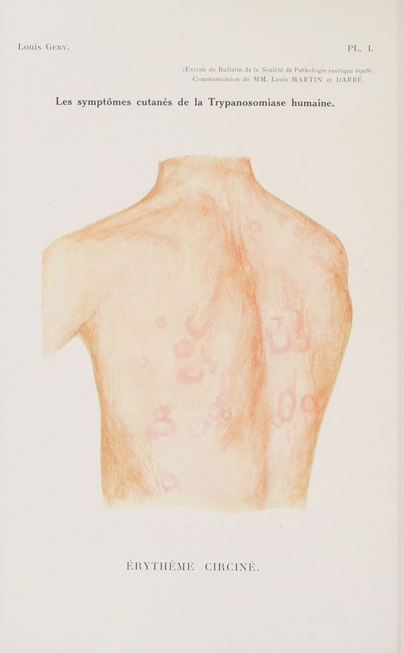 Louis GERY. PISE (Extrait du Bulletin de la Société de Pathologie exotique 1908). Communication de MM. Louis MARTIN et DARRÉ. ÉRYTHÈME CIRCINÉ.