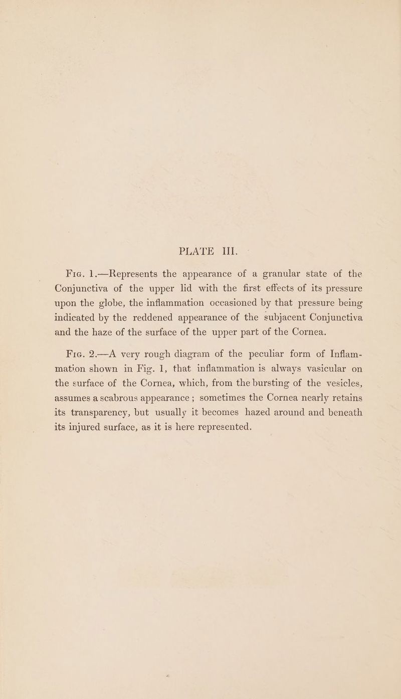 Fie. 1.—Represents the appearance of a granular state of the Conjunctiva of the upper lid with the first effects of its pressure upon the globe, the inflammation occasioned by that pressure being indicated by the reddened appearance of the subjacent Conjunctiva and the haze of the surface of the upper part of the Cornea. Fig. 2.—A very rough diagram of the peculiar form of Inflam- mation shown in Fig. 1, that inflammation is always vasicular on the surface of the Cornea, which, from the bursting of the vesicles, assumes a scabrous appearance ; sometimes the Cornea nearly retains its transparency, but usually it becomes hazed around and beneath its injured surface, as it is here represented.