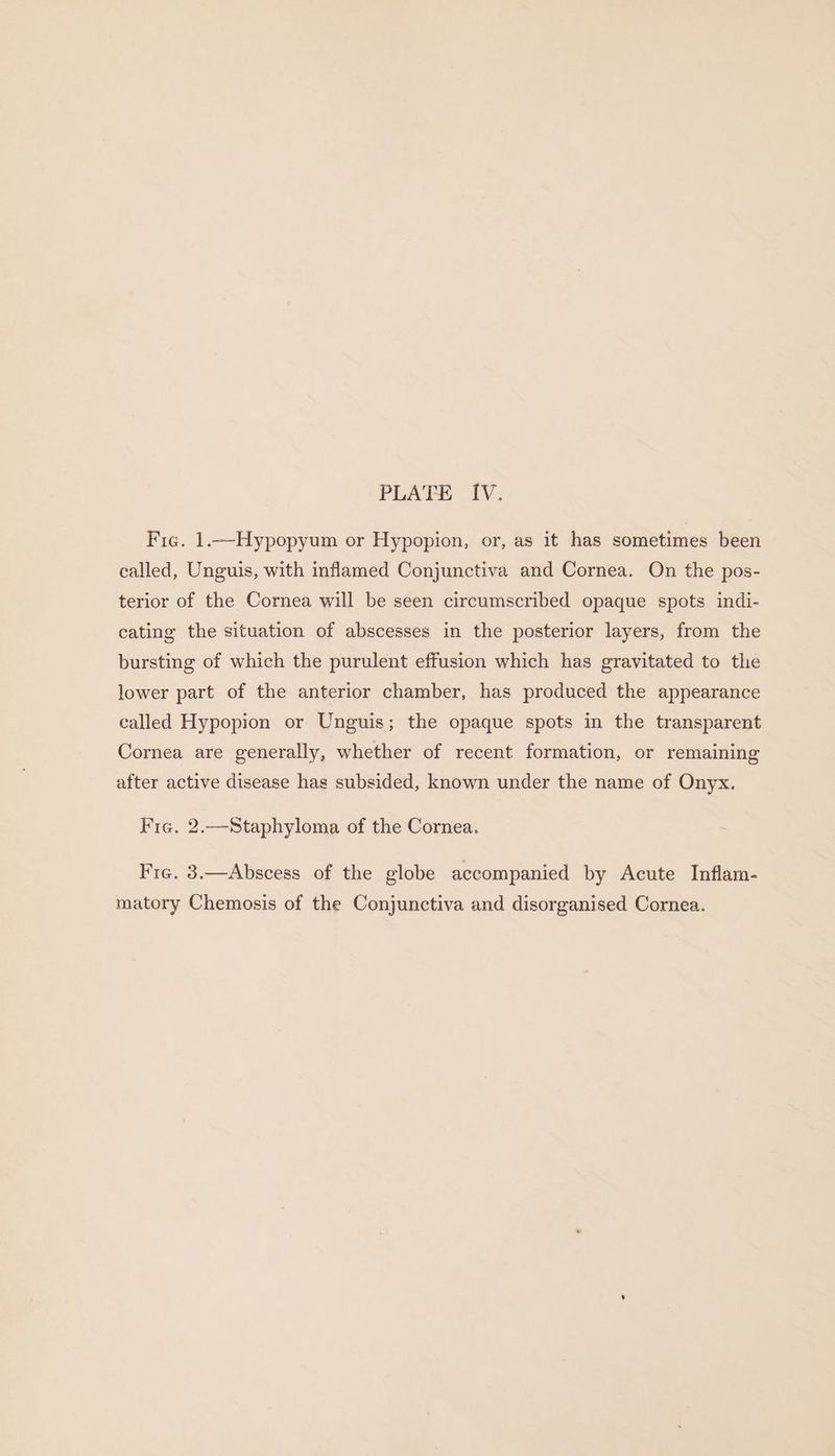 Fie. 1.—Hypopyum or Hypopion, or, as it has sometimes been called, Unguis, with inflamed Conjunctiva and Cornea. On the pos- terior of the Cornea will be seen circumscribed opaque spots indi- cating the situation of abscesses in the posterior layers, from the bursting of which the purulent effusion which has gravitated to the lower part of the anterior chamber, has produced the appearance called Hypopion or Unguis; the opaque spots in the transparent Cornea are generally, whether of recent formation, or remaining after active disease has subsided, known under the name of Onyx. Fie. 2.—Staphyloma of the Cornea. Fic. 3.—Abscess of the globe accompanied by Acute Inflam- matory Chemosis of the Conjunctiva and disorganised Cornea.
