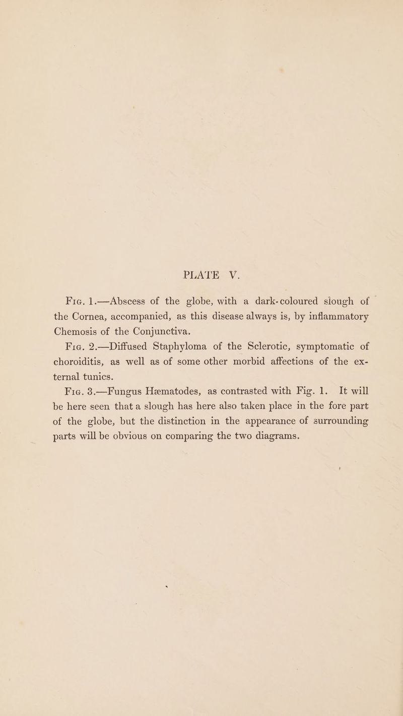 PLATE: Y. Fie, 1.—Abscess of the globe, with a dark-coloured slough of the Cornea, accompanied, as this disease always is, by inflammatory Chemosis of the Conjunctiva. Fie. 2,—Diffused Staphyloma of the Sclerotic, symptomatic of choroiditis, as well as of some other morbid affections of the ex- ternal tunics. Fic. 8.—Fungus Hematodes, as contrasted with Fig. 1. It will be here seen that a slough has here also taken place in the fore part of the globe, but the distinction in the appearance of surrounding parts will be obvious on comparing the two diagrams.