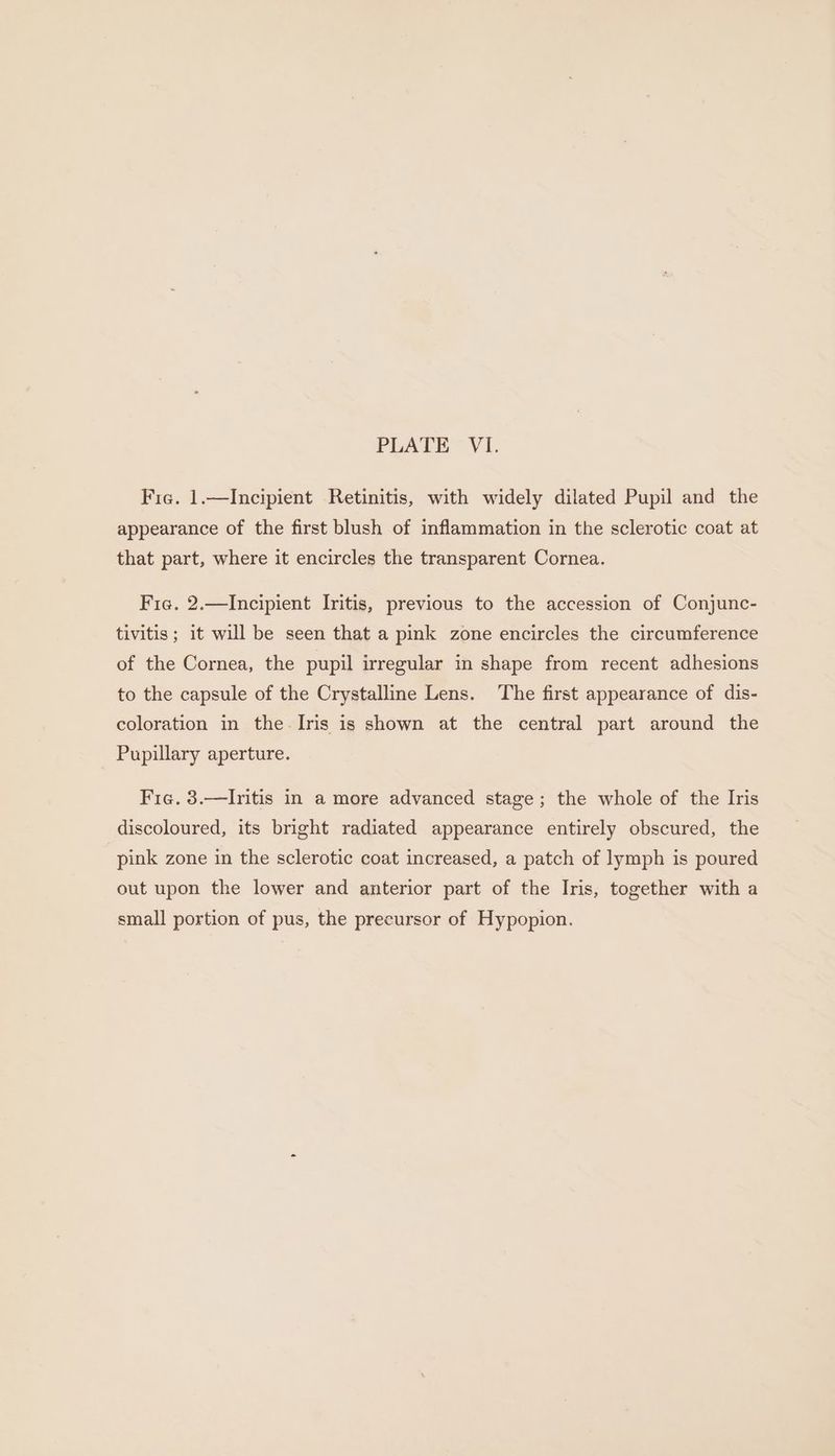 Fic. 1.—Incipient Retinitis, with widely dilated Pupil and the appearance of the first blush of inflammation in the sclerotic coat at that part, where it encircles the transparent Cornea. Fie. 2.—Incipient Iritis, previous to the accession of Conjunc- tivitis; it will be seen that a pink zone encircles the circumference of the Cornea, the pupil irregular in shape from recent adhesions to the capsule of the Crystalline Lens. The first appearance of dis- coloration in the Iris is shown at the central part around the Pupillary aperture. Fig. 3.—Iritis in a more advanced stage; the whole of the Iris discoloured, its bright radiated appearance entirely obscured, the pink zone in the sclerotic coat increased, a patch of lymph is poured out upon the lower and anterior part of the Iris, together with a small portion of pus, the precursor of Hypopion.
