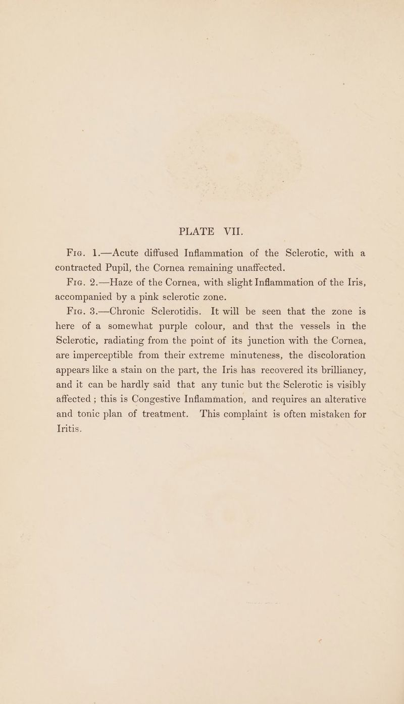 Fie. 1.—Acute diffused Inflammation of the Sclerotic, with a contracted Pupil, the Cornea remaining unaffected. Fie. 2.—Haze of the Cornea, with slight Inflammation of the Iris, accompanied by a pink sclerotic zone. Fie. 3.—Chronic Sclerotidis. It will be seen that the zone is here of a somewhat purple colour, and that the vessels in the Sclerotic, radiating from the point of its junction with the Cornea, are imperceptible from their extreme minuteness, the discoloration appears like a stain on the part, the Iris has recovered its brilliancy, and it can be hardly said that any tunic but the Sclerotic is visibly affected ; this is Congestive Inflammation, and requires an alterative and tonic plan of treatment. This complaint is often mistaken for Iritis.