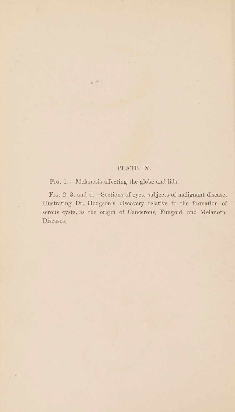 Fie. 1.—Melanosis affecting the globe and lids. Fic. 2, 3, and 4: illustrating Dr. Hodgson’s discovery relative to the formation of Sections of eyes, subjects of malignant disease, serous cysts, as the origin of Cancerous, Fungoid, and Melanotic Diseases.