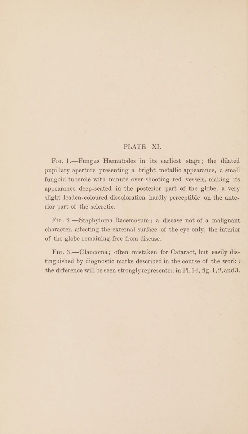 Fic. 1.—Fungus Hematodes in its earliest stage; the dilated pupillary aperture presenting a bright metallic appearance, a small fungoid tubercle with minute over-shooting red vessels, making its appearance deep-seated in the posterior part of the globe, a very slight leaden-coloured discoloration hardly perceptible on the ante- rior part of the sclerotic. Fie. 2.—Staphyloma Racemosum ; a disease not of a malignant character, affecting the external surface of the eye only, the interior of the globe remaining free from disease. Fie. 3.—Glaucoma; often mistaken for Cataract, but easily dis- tinguished by diognostic marks described in the course of the work :