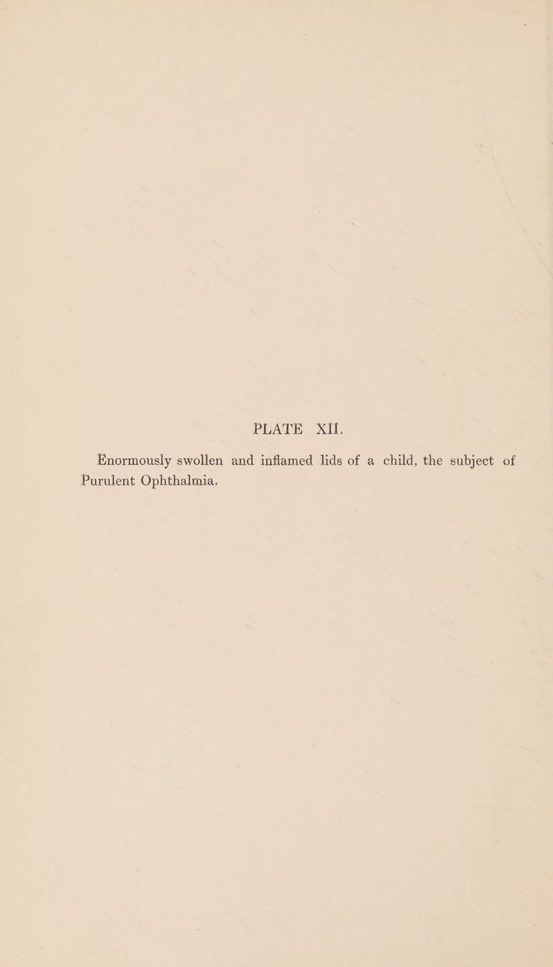 Enormously swollen and inflamed lids of a child, the subject of Purulent Ophthalmia.
