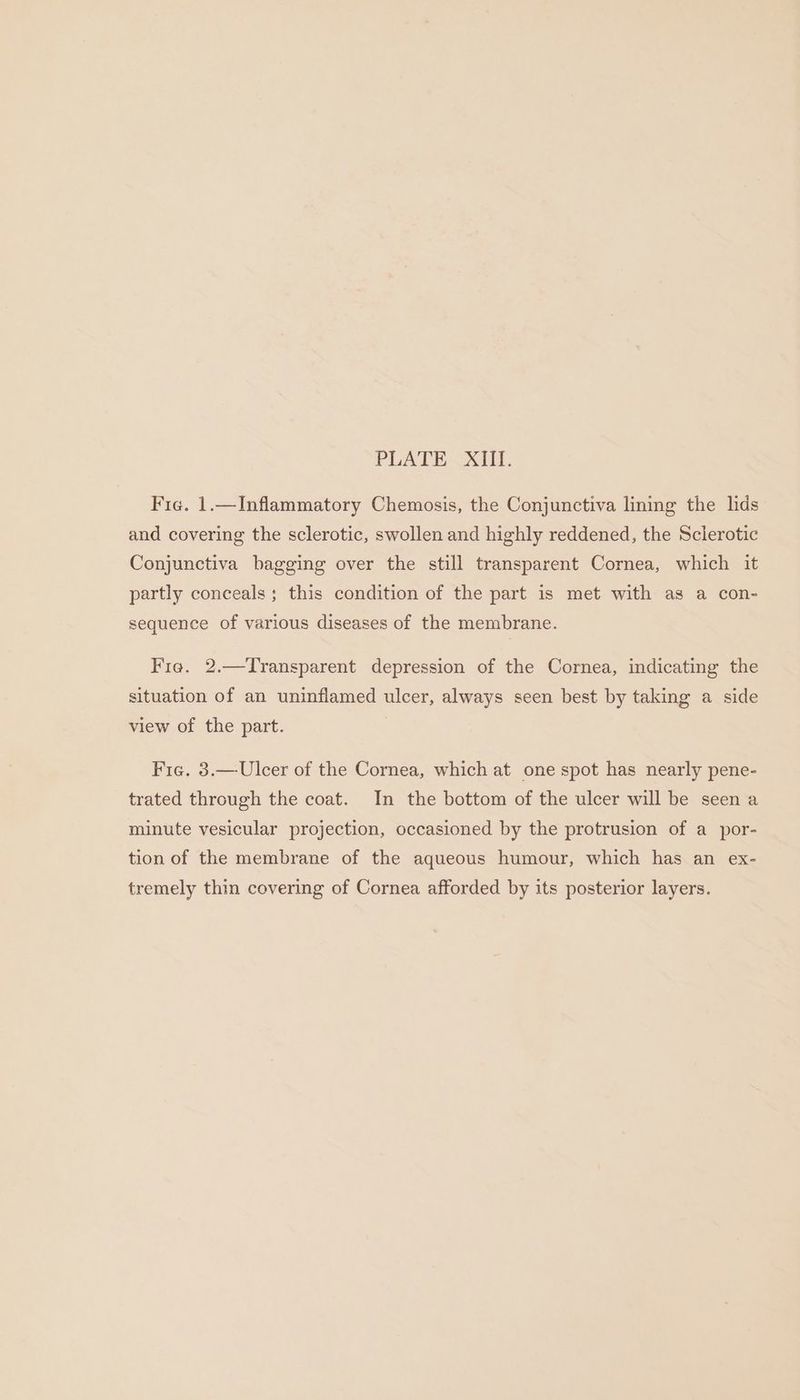 Fie. 1.—Inflammatory Chemosis, the Conjunctiva lining the lids and covering the sclerotic, swollen and highly reddened, the Sclerotic Conjunctiva bagging over the still transparent Cornea, which it partly conceals ; this condition of the part is met with as a con- sequence of various diseases of the membrane. Fre. 2.—Transparent depression of the Cornea, indicating the situation of an uninflamed ulcer, always seen best by taking a side view of the part. Fie. 3.— Ulcer of the Cornea, which at one spot has nearly pene- trated through the coat. In the bottom of the ulcer will be seen a minute vesicular projection, occasioned by the protrusion of a por- tion of the membrane of the aqueous humour, which has an ex- tremely thin covering of Cornea afforded by its posterior layers.