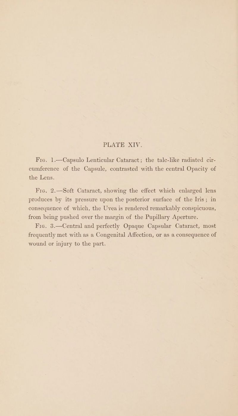 Fre. 1.—Capsulo Lenticular Cataract; the talc-like radiated cir- cumference of the Capsule, contrasted with the central Opacity of the Lens. Fre. 2.—Soft Cataract, showing the effect which enlarged lens produces by its pressure upon the posterior surface of the Iris; in consequence of which, the Uvea is rendered remarkably conspicuous, from being pushed over the margin of the Pupillary Aperture. Fig. 3.—Central and perfectly Opaque Capsular Cataract, most frequently met with as a Congenital Affection, or as a consequence of wound or injury to the part.