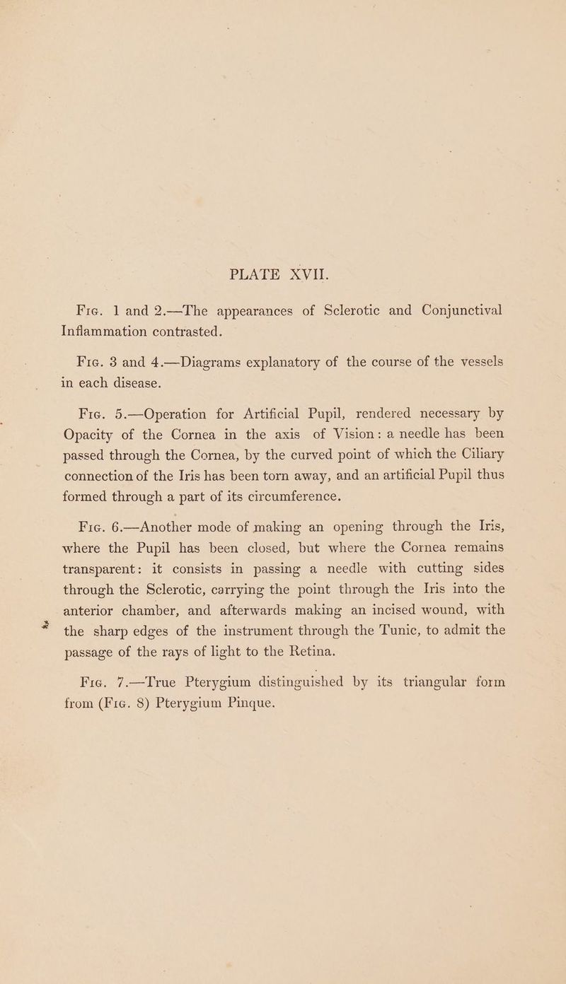 he Fig. 1 and 2.—The appearances of Sclerotic and Conjunctival Inflammation contrasted. Fie. 3 and 4.—Diagrams explanatory of the course of the vessels in each disease. Fie. 5.—Operation for Artificial Pupil, rendered necessary by Opacity of the Cornea in the axis of Vision: a needle has been passed through the Cornea, by the curved point of which the Ciliary connection of the Iris has been torn away, and an artificial Pupil thus formed through a part of its circumference. Fig. 6.—Another mode of making an opening through the Ins, where the Pupil has been closed, but where the Cornea remains transparent: it consists in passing a needle with cutting sides through the Sclerotic, carrying the point through the Ins into the anterior chamber, and afterwards making an incised wound, with the sharp edges of the instrument through the Tunic, to admit the passage of the rays of light to the Retina. | Fie. 7.—True Pterygium distinguished by its triangular form from (Fie. 8) Pterygium Pinque.