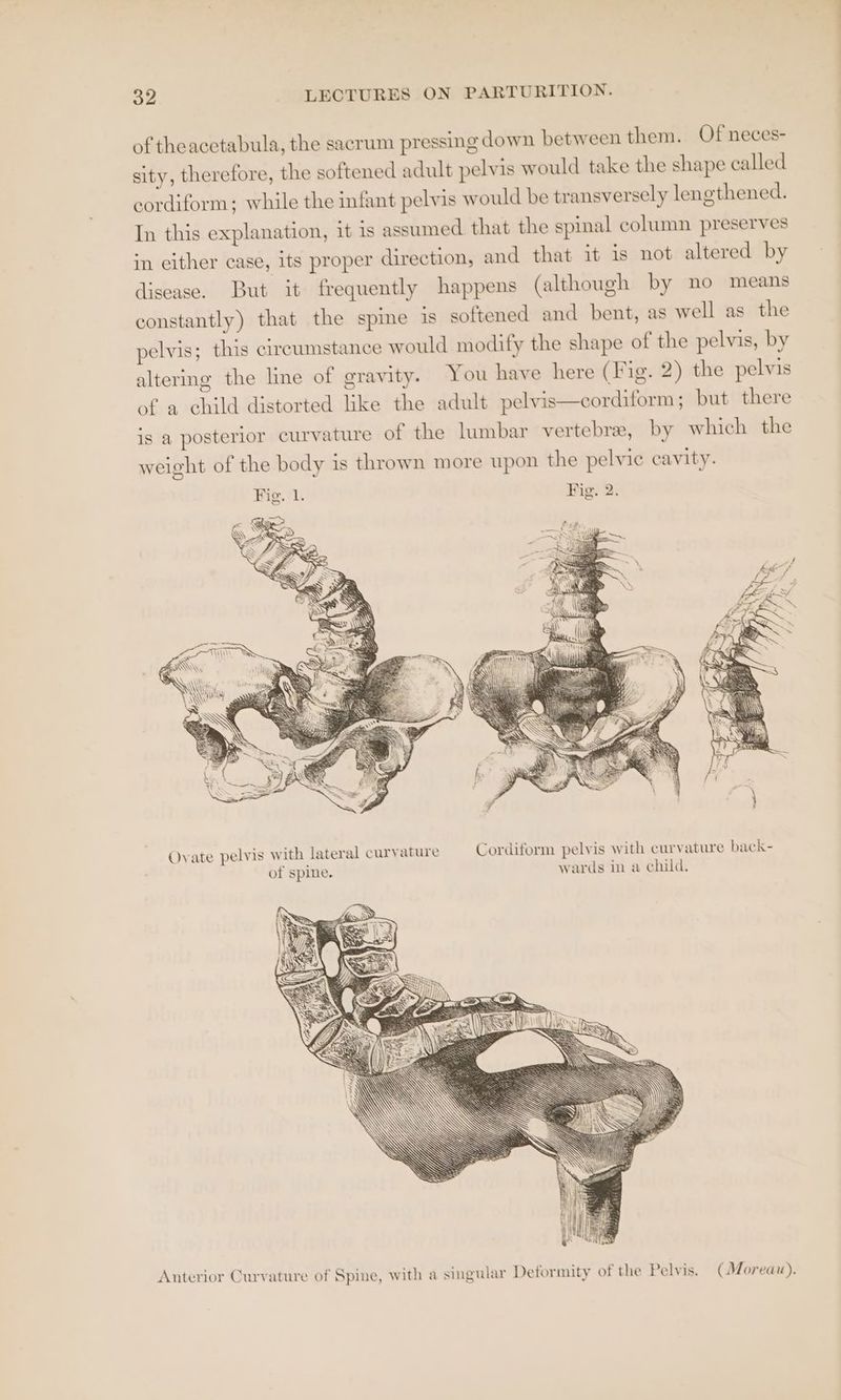 of theacctabula, the sacrum pressing down between them. Of neces- sity, therefore, the softened adult pelvis would take the shape called cordiform; while the infant pelvis would be transversely lengthened. In this explanation, it is assumed that the spinal column preserves in either case, its proper direction, and that it is not altered by disease. But it frequently happens (although by no means constantly) that the spme is softened and bent, as well as the pelvis; this circumstance would modify the shape of the pelvis, by altering the line of gravity. You have here (Fig. 2) the pelvis of a child distorted like the adult pelvis—cordiform ; but there is a posterior curvature of the lumbar vertebra, by which the Oyate pelvis with lateral curyature Cordiform pelvis with curvature back- of spine, wards in a child. Anterior Curvature of Spine, with a singular Deformity of the Pelvis. (Moreau).