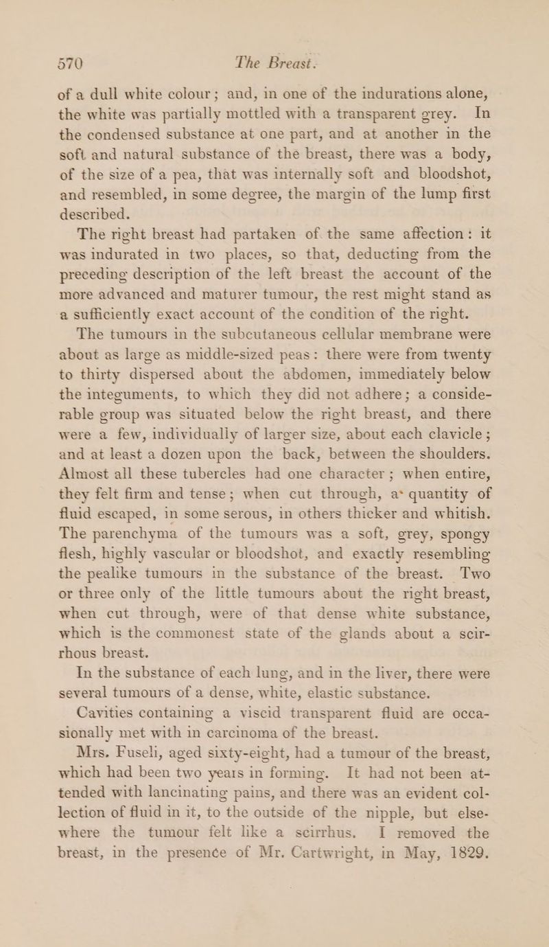 of a dull white colour; and, in one of the indurations alone, the white was partially mottled with a transparent grey. In the condensed substance at one part, and at another in the soft and natural substance of the breast, there was a body, of the size of a pea, that was internally soft and bloodshot, and resembled, in some degree, the margin of the lump first described. The right breast had partaken of the same affection: it was indurated in two places, so that, deducting from the preceding description of the left breast the account of the more advanced and maturer tumour, the rest might stand as a sufficiently exact account of the condition of the right. The tumours in the subcutaneous cellular membrane were about as large as middle-sized peas: there were from twenty to thirty dispersed about the abdomen, immediately below the integuments, to which they did not adhere; a conside- rable group was situated below the right breast, and there were a few, individually of larger size, about each clavicle ; and at least a dozen upon the back, between the shoulders. Almost all these tubercles had one character ; when entire, they felt firm and tense; when cut through, a* quantity of fluid escaped, in some serous, in others thicker and whitish. The parenchyma of the tumours was a soft, grey, spongy flesh, highly vascular or bloodshot, and exactly resembling the pealike tumours in the substance of the breast. Two or three only of the little tumours about the right breast, when cut through, were of that dense white substance, which is the commonest state of the glands about a scir- rhous breast. In the substance of each lung, and in the liver, there were several tumours of a dense, white, elastic substance. Cavities containing a viscid transparent fluid are occa- sionally met with in carcinoma of the breast. Mrs. Fuseli, aged sixty-eight, had a tumour of the breast, which had been two years in forming. It had not been at- tended with lancinating pains, and there was an evident col- lection of fluid in it, to the outside of the nipple, but else- where the tumour felt like a scirrhus. I removed the breast, in the presence of Mr. Cartwright, in May, 1829.