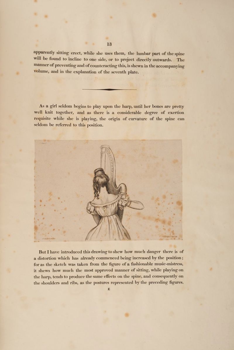 apparently sitting erect, while she uses them, the lumbar part of the spine will be found to incline to one side, or to project directly outwards. The manner of preventing and of counteracting this, is shewn in the Socom pana volume, and in the explanation of the seventh plate. — As a girl seldom begins to play upon the harp, until her bones are pretty well knit together, and as there is a considerable degree of exertion requisite while she is playing, the origin of curvature of the spine can seldom be referred to this position. - Hate D. 4 * @Etenedby Tlandseer . * £ = ee = J F t : \ : / \ ¢ Hi ; ; : i On, fh ‘il iI # ae : . *. * * bs * # ” ‘ ; & . m ‘A j : “ ; b * * “ a is sa : ; a § ; Q % | b> . we .* | J. lO ’ wa Sas = ae : re al 7 . * @. { P > a. Fg t Drawi by CLanaseer . :, But [ have introduced this drawing to shew how much danger there is of a distortion which has already commenced being increased by the position ; for as the sketch was taken from the figure of a fashionable music-mistress, it shews how much the most approved manner of sitting, while playing on the harp, tends to produce the same effects on the spine, and consequently on the shoulders and ribs, as the postures represented by the preceding figures. E