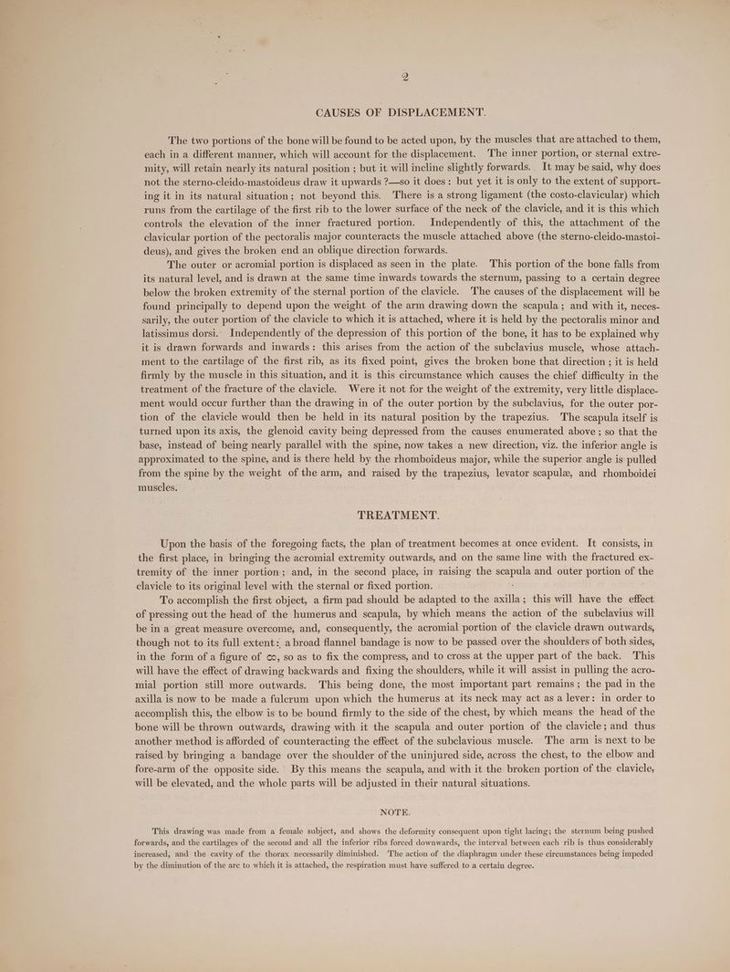 yy CAUSES OF DISPLACEMENT. The two portions of the bone will be found to be acted upon, by the muscles that are attached to them, each in a different manner, which will account for the displacement. The inner portion, or sternal extre- mity, will retain nearly its natural position ; but it will incline slightly forwards. It may be said, why does not the sterno-cleido-mastoideus draw it upwards ?—so it does: but yet it is only to the extent of support- ing it in its natural situation; not beyond this. ‘There is a strong ligament (the costo-clavicular) which runs from the cartilage of the first rib to the lower surface of the neck of the clavicle, and it is this which ~ controls the elevation of the inner fractured portion. Independently of this, the attachment of the clavicular portion of the pectoralis major counteracts the muscle attached above (the sterno-cleido-mastoi- deus), and gives the broken end an oblique direction forwards. The outer or acromial portion is displaced as seen in the plate. This portion of the bone falls from its natural level, and is drawn at the same time inwards towards the sternum, passing to a certain degree below the broken extremity of the sternal portion of the clavicle. ‘The causes of the displacement will be found principally to depend upon the weight of the arm drawing down the scapula; and with it, neces- sarily, the outer portion of the clavicle to which it is attached, where it is held by the pectoralis minor and latissimus dorsi. Independently of the depression of this portion of the bone, it has to be explained why it is drawn forwards and inwards: this arises from the action of the subclavius muscle, whose attach- ment to the cartilage of the first rib, as its fixed point, gives the broken bone that direction ; it is held firmly by the muscle in this situation, and it is this circumstance which causes the chief difficulty in the treatment of the fracture of the clavicle. Were it not for the weight of the extremity, very little displace- ment would occur further than the drawing in of the outer portion by the subclavius, for the outer por- tion of the clavicle would then be held in its natural position by the trapezius. The scapula itself is turned upon its axis, the glenoid cavity being depressed from the causes enumerated above ; so that the base, instead of being nearly parallel with the spine, now takes a new direction, viz. the inferior angle is approximated to the spine, and is there held by the rhomboideus major, while the superior angle is pulled from the spine by the weight of the arm, and raised by the trapezius, levator scapule, and rhomboidei muscles. TREATMENT. Upon the basis of the foregoing facts, the plan of treatment becomes at once evident. It consists, in the first place, in bringing the acromial extremity outwards, and on the same line with the fractured ex- tremity of the inner portion; and, in the second place, in raising the — and outer portion of the clavicle to its original level with the sternal or fixed portion. To accomplish the first object, a firm pad should be adapted to the axilla; this will have the effect of pressing out the head of the humerus and scapula, by which means the action of the subclavius will be in a great measure overcome, and, consequently, the acromial portion of the clavicle drawn outwards, though not to its full extent: abroad flannel bandage is now to be passed over the shoulders of both sides, in the form of a figure of oo, so as to fix the compress, and to cross at the upper part of the back. This will have the effect of drawing backwards and fixing the shoulders, while it will assist in pulling the acro- mial portion still more outwards. This being done, the most important part remains; the pad in the axilla is now to be made a fulcrum upon which the humerus at its neck may act as a lever: in order to accomplish this, the elbow is to be bound firmly to the side of the chest, by which means the head of the bone will be thrown outwards, drawing with it the scapula and outer portion of the clavicle; and thus another method is afforded of counteracting the effect of the subclavious muscle. The arm is next to be raised by bringing a bandage over the shoulder of the uninjured side, across the chest, to the elbow and fore-arm of the opposite side. By this means the scapula, and with it the broken portion of the clavicle, will be elevated, and the whole parts will be adjusted in their natural situations. NOTE. This drawing was made from a female subject, and shows the deformity consequent upon tight lacing; the sternum being pushed forwards, and the cartilages of the second and all the inferior ribs forced downwards, the interval between each rib is thus considerably increased, and the cavity of the thorax necessarily diminished. The action of the diaphragm under these circumstances being impeded by the diminution of the are to which it is attached, the respiration must have suffered to a certain degree.