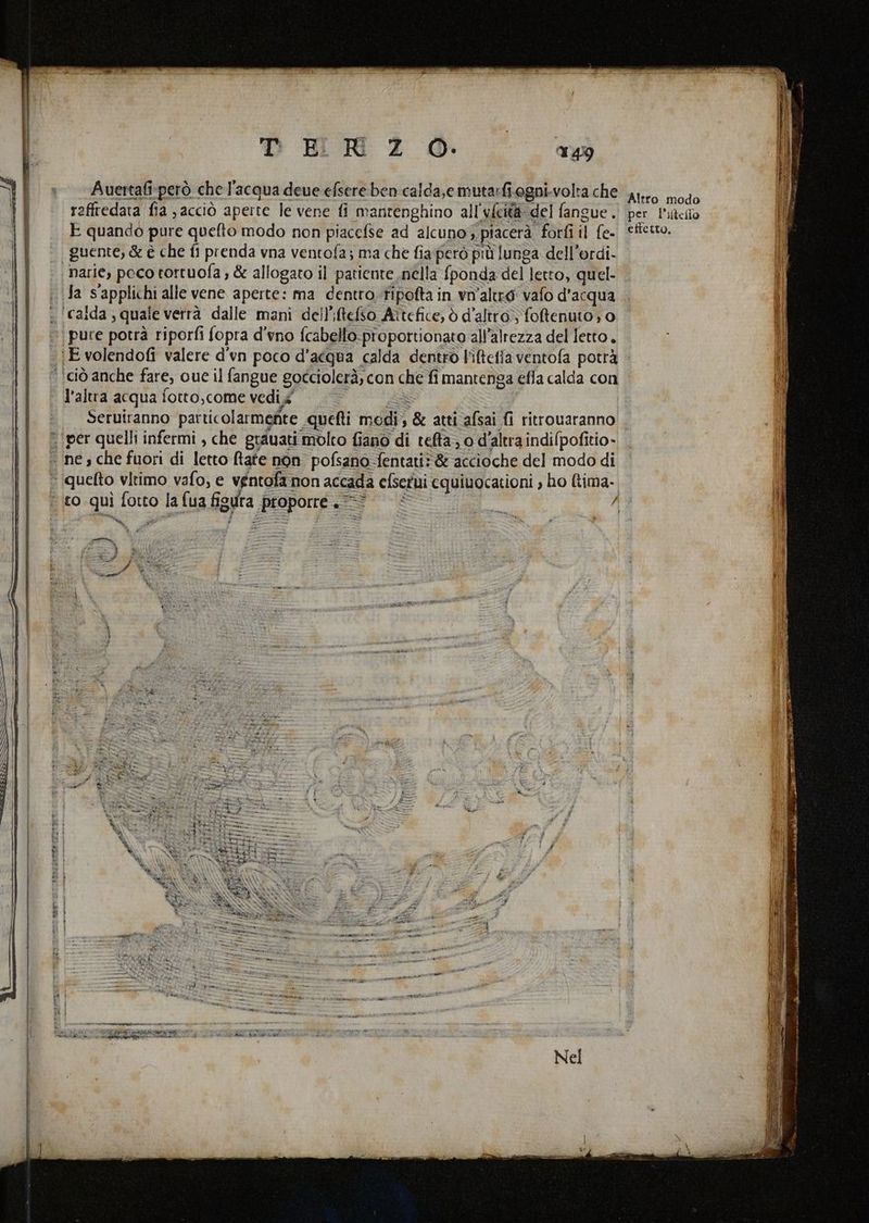 Auertafi-però che l'acqua deue efsere ben calda,emutarfiegni.volta che raffredata fia ,acciò aperte le vene fi mantenghino all'ufcità: del fangue . E quando pure quefto modo non piacefse ad alcuno; piacerà forfi il fe- | guente, & è che fi prenda vna ventofa; ma che fia però più lunga dell’ordi- narie, poco totruofa ; & allogato il patiente nella fponda del letto, quel- fa s'applichi alle vene aperte: ma dentro fipofta in vn'altegi vafo d'acqua « (calda, quale verrà dalle mani dell’iltefso Aîtefice, ò d'altro; fotenuto; o pure potrà riporfi fopra d'vno fcabello-proportionato all’alrezza del letto. :E volendofi valere d'un poco d’acqua calda dentro l'iltefia ventofa potrà [ciò anche fare, oue il fangue gocciolerà, con che fi mantenga efla calda con l’altra acqua fotto,come vedix Al = — Seruiranno particolarmente quefti medi, & atti afsai fi ritrouaranno ‘per quelli infermi , che grauatimolto fiano di tefta; o d'altra indi(pofitio- “ne; che fuori di letto [tate non pofsano fentati> & accioche del modo di ‘iquefto vitimo vafo, e véntofa non accada cfsetui cquiuocationi , ho ltima- f %