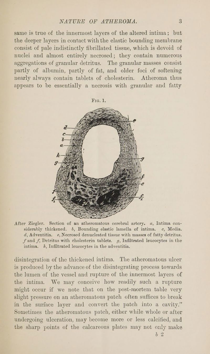 same is true of the innermost layers of the altered intima; but the deeper layers in contact with the elastic bounding membrane consist of pale indistinctly fibrillated tissue, which is devoid of nuclei and almost entirely necrosed; they contain numerous ageregations of granular detritus. The granular masses consist partly of albumin, partly of fat, and older foci of softening nearly always contain tablets of cholesterin. Atheroma thus appears to be essentially a necrosis with granular and fatty After Ziegler. Section of an atheromatous cerebral artery. a, Intima con- siderably thickened. 6, Bounding elastic lamella of intima. c, Media. d, Adventitia. e, Necrosed denucleated tissue with masses of fatty detritus. f and f, Detritus with cholesterin tablets. g, Infiltrated leucocytes in the intima. h, Infiltrated leucocytes in the adventitia. disintegration of the thickened intima. The atheromatous ulcer is produced by the advance of the disintegrating process towards the lumen of the vessel and rupture of the innermost layers of the intima. We may conceive how readily such a rupture might occur if we note that on the post-mortem table very slight pressure on an atheromatous patch often suffices to break in the suriace layer and convert the patch into a cavity.” Sometimes the atheromatous patch, either while whole or after undergoing ulceration, may become more or less calcified, and the sharp points of the calcareous plates may not only make b 2