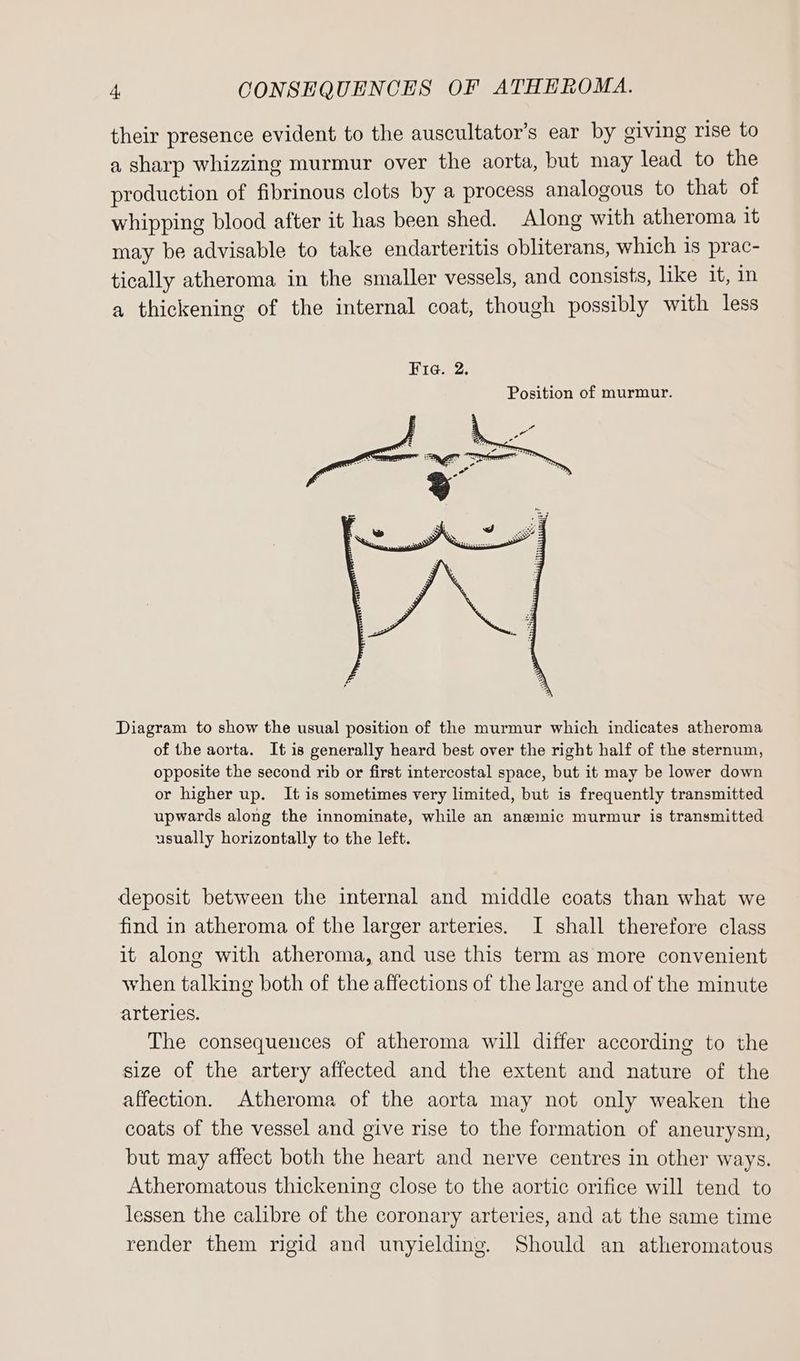 their presence evident to the auscultator’s ear by giving rise to a sharp whizzing murmur over the aorta, but may lead to the production of fibrinous clots by a process analogous to that of whipping blood after it has been shed. Along with atheroma it may be advisable to take endarteritis obliterans, which is prac- tically atheroma in the smaller vessels, and consists, like it, in a thickening of the internal coat, though possibly with less Position of murmur. Diagram to show the usual position of the murmur which indicates atheroma of the aorta. It is generally heard best over the right half of the sternum, opposite the second rib or first intercostal space, but it may be lower down or higher up. It is sometimes very limited, but is frequently transmitted upwards along the innominate, while an anemic murmur is transmitted usually horizontally to the left. deposit between the internal and middle coats than what we find in atheroma of the larger arteries. I shall therefore class it along with atheroma, and use this term as more convenient when talking both of the affections of the large and of the minute arteries. The consequences of atheroma will differ according to the size of the artery affected and the extent and nature of the affection. Atheroma of the aorta may not only weaken the coats of the vessel and give rise to the formation of aneurysm, but may affect both the heart and nerve centres in other ways. Atheromatous thickening close to the aortic orifice will tend to lessen the calibre of the coronary arteries, and at the same time render them rigid and unyielding. Should an atheromatous