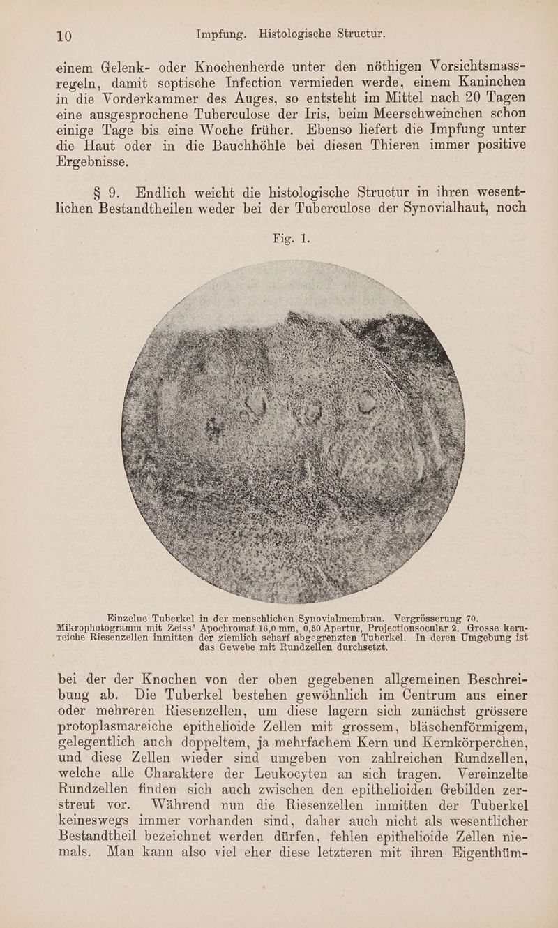 einem @elenk- oder Knochenherde unter den nöthigen Vorsichtsmass- regeln, damit septische Infeetion vermieden werde, einem Kaninchen in die Vorderkammer des Auges, so entsteht im Mittel nach 20 Tagen eine ausgesprochene Tuberculose der Iris, beim Meerschweinchen schon einige Tage bis eine Woche früher. Ebenso liefert die Impfung unter die Haut oder in die Bauchhöhle bei diesen Thieren immer positive Ergebnisse. 8 9. Endlich weicht die histologische Structur in ihren wesent- lichen Bestandtheilen weder bei der Tuberculose der Synovialhaut, noch Einzelne Tuberkel in der menschlichen Synovialmembran. Vergrösserung 70. Mikrophotogramm mit Zeiss’ Apochromat 16,0 mm, 0,30 Apertur, Projectionsocular 2. Grosse kern- reiche Riesenzellen inmitten der ziemlich scharf abge renzten Tuberkel. In deren Umgebung ist das Gewebe mit Rundzellen durchsetzt. bei der der Knochen von der oben gegebenen allgemeinen Beschrei- bung ab. Die Tuberkel bestehen gewöhnlich im Centrum aus einer oder mehreren Riesenzellen, um diese lagern sich zunächst grössere protoplasmareiche epithelioide Zellen mit grossem, bläschenförmigem, gelegentlich auch doppeltem, ja mehrfachem Kern und Kernkörperchen, und diese Zellen wieder sind umgeben von zahlreichen Rundzellen, welche alle Charaktere der Leukocyten an sich tragen. Vereinzelte Rundzellen finden sich auch zwischen den epithelioiden Gebilden zer- streut vor. Während nun die Riesenzellen inmitten der Tuberkel keineswegs immer vorhanden sind, daher auch nicht als wesentlicher Bestandtheil bezeichnet werden dürfen, fehlen epithelioide Zellen nie- mals. Man kann also viel eher diese letzteren mit ihren Eigenthüm-