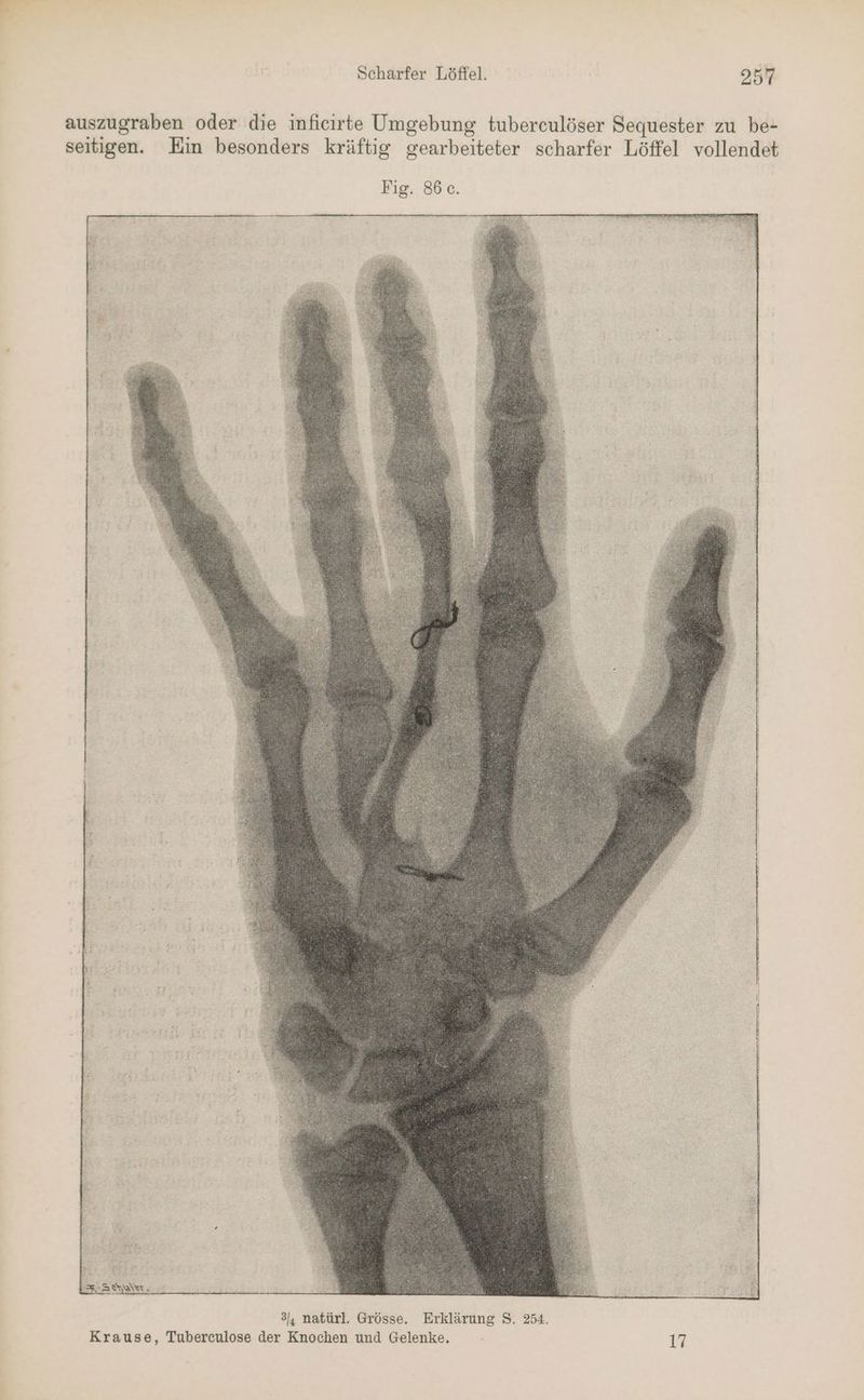 auszugraben oder die inficirte Umgebung tuberculöser Sequester zu be- seitigen. Ein besonders kräftig gearbeiteter scharfer Löffel vollendet Fig. 86.c. 4 EIEDNSE 34 natürl. Grösse. Erklärung S. 254. Krause, Tuberculose der Knochen und Gelenke. 17