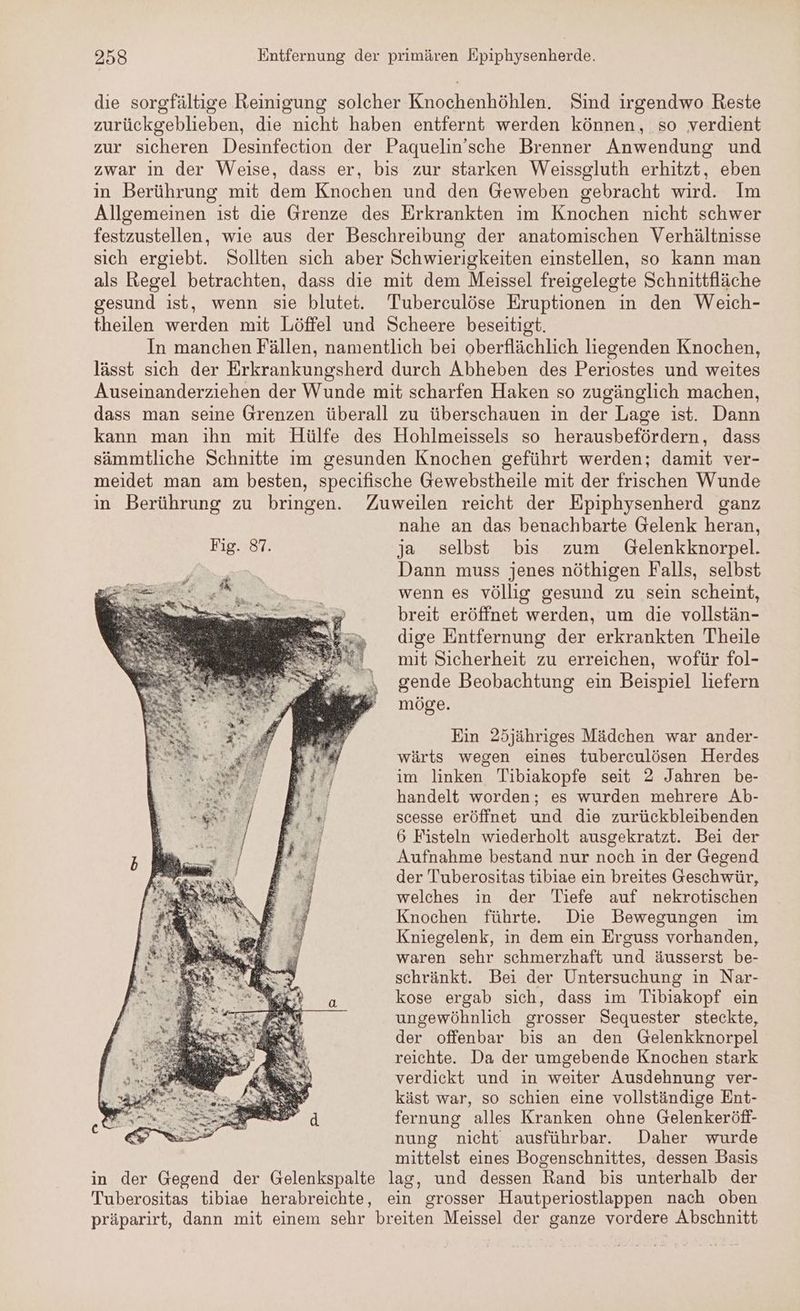 die sorgfältige Reinigung solcher Knochenhöhlen. Sind irgendwo Reste zurückgeblieben, die nicht haben entfernt werden können, so verdient zur sicheren Desinfection der Paquelin’sche Brenner Anwendung und zwar in der Weise, dass er, bis zur starken Weissgluth erhitzt, eben in Berührung mit dem Knochen und den Geweben gebracht wird. Im Allgemeinen ist die Grenze des Erkrankten im Knochen nicht schwer festzustellen, wie aus der Beschreibung der anatomischen Verhältnisse sich ergiebt. Sollten sich aber Schwierigkeiten einstellen, so kann man als Regel betrachten, dass die mit dem Meissel freigelegte Schnittfläche gesund ist, wenn sie blutet. Tuberculöse Eruptionen in den Weich- theilen werden mit Löffel und Scheere beseitigt. In manchen Fällen, namentlich bei oberflächlich liegenden Knochen, lässt sich der Erkrankungsherd durch Abheben des Periostes und weites Auseinanderziehen der Wunde mit scharfen Haken so zugänglich machen, dass man seine Grenzen überall zu überschauen in der Lage ist. Dann kann man ihn mit Hülfe des Hohlmeissels so herausbefördern, dass sämmtliche Schnitte im gesunden Knochen geführt werden; damit ver- meidet man am besten, specifische Gewebstheile mit der frischen Wunde in Berührung zu bringen. Zuweilen reicht der Epiphysenherd ganz nahe an das benachbarte Gelenk heran, Fig. 87. ja selbst bis zum Gelenkknorpel. ng Dann muss jenes nöthigen Falls, selbst Mm wenn es völlig gesund zu sein scheint, breit eröffnet werden, um die vollstän- dige Entfernung der erkrankten Theile mit Sicherheit zu erreichen, wofür fol- gende Beobachtung ein Beispiel liefern möge. Ein 25jähriges Mädchen war ander- wärts wegen eines tuberculösen Herdes im linken Tibiakopfe seit 2 Jahren be- handelt worden; es wurden mehrere Ab- scesse eröffnet und die zurückbleibenden 6 Fisteln wiederholt ausgekratzt. Bei der Aufnahme bestand nur noch in der Gegend der Tuberositas tibiae ein breites Geschwür, welches in der Tiefe auf nekrotischen Knochen führte. Die Bewegungen im Kniegelenk, in dem ein Erguss vorhanden, waren sehr schmerzhaft und äusserst be- schränkt. Bei der Untersuchung in Nar- kose ergab sich, dass im Tibiakopf ein ungewöhnlich grosser Sequester steckte, der offenbar bis an den Gelenkknorpel reichte. Da der umgebende Knochen stark verdickt und in weiter Ausdehnung ver- käst war, so schien eine vollständige Ent- fernung alles Kranken ohne Gelenkeröff- nung nicht ausführbar. Daher wurde mittelst eines Bogenschnittes, dessen Basis in der Gegend der Gelenkspalte lag, und dessen Rand bis unterhalb der Tuberositas tibiae herabreichte, ein grosser Hautperiostlappen nach oben präparirt, dann mit einem sehr breiten Meissel der ganze vordere Abschnitt