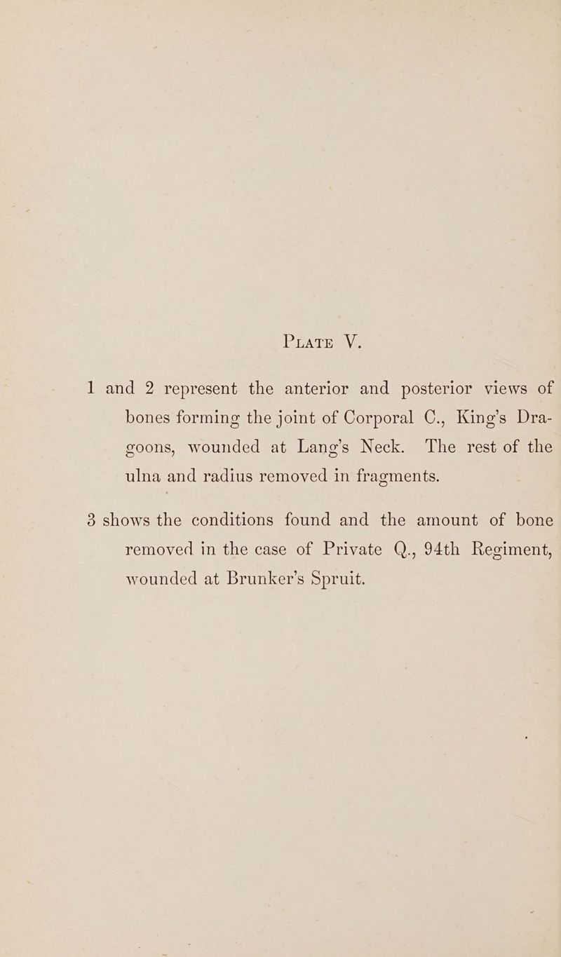 PATE Ve 1 and 2 represent the anterior and posterior views of bones forming the joint of Corporal C., King’s Dra- goons, wounded at Lang’s Neck. The rest of the ulna and radius removed in fragments. 3 shows the conditions found and the amount of bone removed in the case of Private Q., 94th Regiment, wounded at Brunker’s Spruit.
