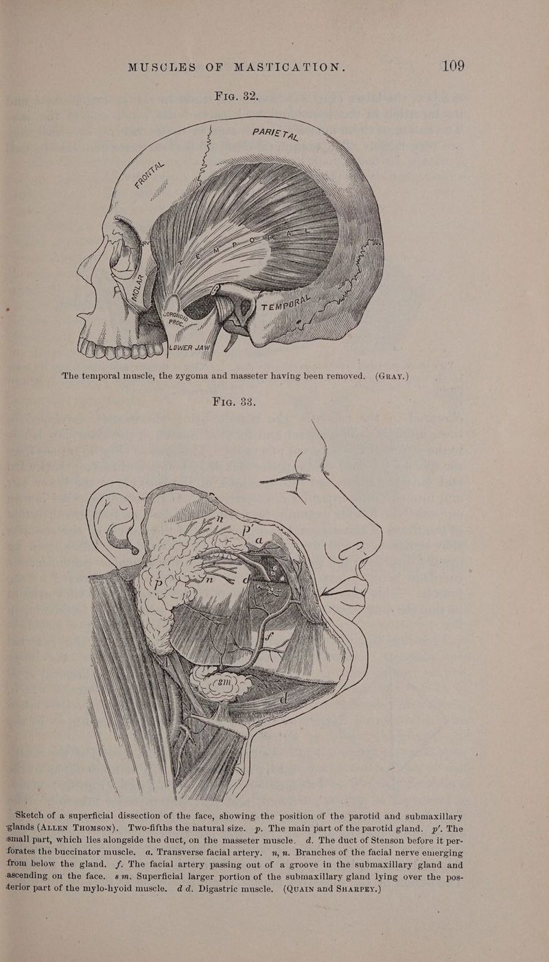 a7 ) y] / \) oo ull } | yy wy ) Mh The temporal muscle, the zygoma and masseter having been removed. (GRAY.) Fig. 383. \ ne : 3 ae ease “ his Z BE . Z 3 B22 ZINN BSS SSS or SC RN S ea \ WS s Ce \ a ay p. Facet MG Wy \S gates i hi roreal Sketch of a superficial dissection of the face, showing the position of the parotid and submaxillary glands (ALLEN THomson). Two-fifths the natural size. p. The main part of the parotid gland. p/. The ‘small part, which lies alongside the duct, on the masseter muscle. d. The duct of Stenson before it per- forates the buccinator muscle. a. Transverse facial artery. n,n. Branches of the facial nerve emerging from below the gland. f. The facial artery passing out of a groove in the submaxillary gland and ascending on the face. sm. Superficial larger portion of the submaxillary gland lying over the pos- terior part of the mylo-hyoid muscle. dd. Digastric muscle. (QUAIN and SHARPEY.)