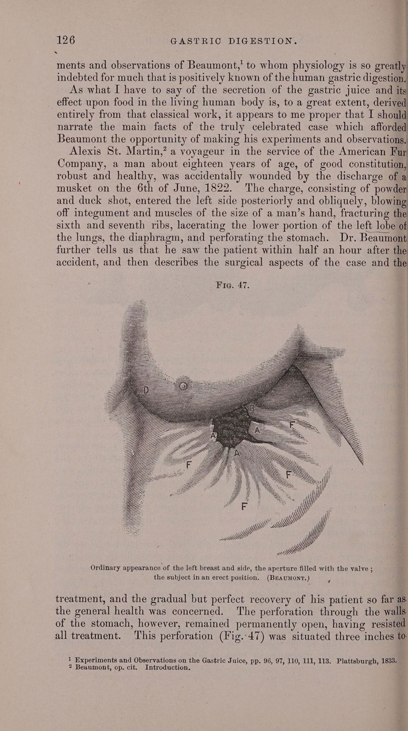 ments and observations of Beaumont,’ to whom physiology is so greatly indebted for much that is positively known of the human gastric digestion, As what I have to say of the secretion of the gastric juice and its effect upon food in the living human body is, to a great extent, derived entirely from that classical work, it appears to me proper that I should narrate the main facts of the truly celebrated case which afforded Beaumont the opportunity of making his experiments and observations, Alexis St. Martin,” a voyageur in the service of the American Fur Company, a man about eighteen years of age, of good constitution, robust and healthy, was accidentally wounded by the discharge of a musket on the 6th of June, 1822. The charge, consisting of powder and duck shot, entered the left side posteriorly and obliquely, blowing off integument and muscles of the size of a man’s hand, fracturing the sixth and seventh ribs, lacerating the lower portion of the left lobe of the lungs, the diaphragm, and perforating the stomach. Dr. Beaumont further tells us that he saw the patient within half an hour after the accident, and then describes the surgical aspects of the case and the Y a | Ordinary appearance of the left breast and side, the aperture filled with the valve ; the subject in an erect position. (BeAUMONT.) ; treatment, and the gradual but perfect recovery of his patient so far as the general health was concerned. ‘The perforation through the walls of the stomach, however, remained permanently open, having resisted all treatment. ‘This perforation (Fig.-47) was situated three inches to 1 Experiments and Observations on the Gastric Juice, pp. 96, 97, 110, 111, 113. Plattsburgh, 1833. 2 Beaumont, op. cit. Introduction.