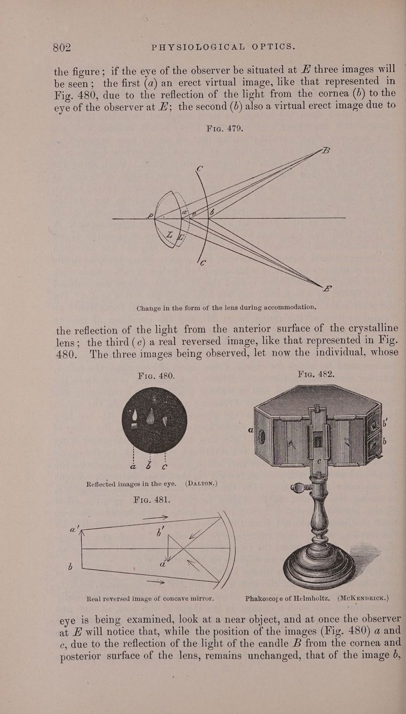 the figure; if the eye of the observer be situated at H three images will — be seen; the first (a) an erect virtual image, like that represented in Fig. 480, due to the reflection of the light from the cornea (6) to the eye of the observer at H; the second (6) also a virtual erect image due to Change in the form of the lens during accommodation, the reflection of the light from the anterior surface of the crystalline lens; the third(c) a real reversed image, like that represented in Hig. 480. The three images being observed, let now the individual, whose Fig. 480. Fia, 482. —————————————— —————————————— oe ——————S—— ===> ait) Reflected images in the eye. (Da.ron.) Fia. 481. _——_> Real reversed image of concave mirror. Phakoscope of Helmholtz. (McKeEnprick.) eye is being examined, look at a near object, and at once the observer at EH will notice that, while the position of the images (Fig. 480) a and c, due to the reflection of the light of the candle B from the cornea and posterior surface of the lens, remains unchanged, that of the image 0,