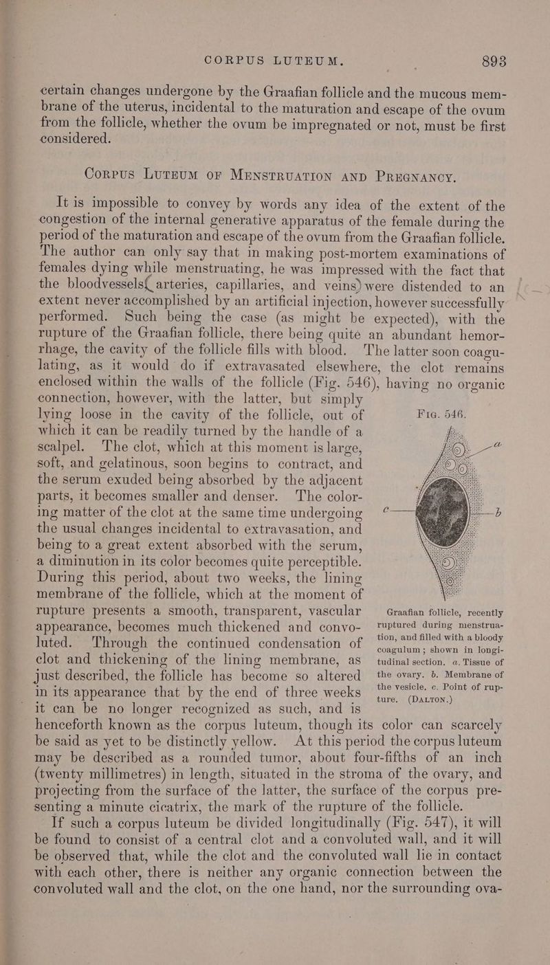 _— en nodes Pane CORPUS LUTEUM. 8938 certain changes undergone by the Graafian follicle and the mucous mem- brane of the uterus, incidental to the maturation and escape of the ovum from the follicle, whether the ovum be impregnated or not, must be first considered. Corpus LurEuM or MENSTRUATION AND PREGNANCY. It is impossible to convey by words any idea of the extent of the congestion of the internal generative apparatus of the female during the period of the maturation and escape of the ovum from the Graafian follicle. The author can only say that in making post-mortem examinations of females dying while menstruating, he was impressed with the fact that extent never accomplished by an artificial injection, however successfully performed. Such being the case (as might be expected), with the rupture of the Graafian follicle, there being quite an abundant hemor- rhage, the cavity of the follicle fills with blood. The latter soon coagu- lating, as it would do if extravasated elsewhere, the clot remains enclosed within the walls of the follicle (Fig. 546), having no organic connection, however, with the latter, but simply lying loose in the cavity of the follicle, out of Fira. 546. which it can be readily turned by the handle of a scalpel. The clot, which at this moment is large, soft, and gelatinous, soon begins to contract, and the serum exuded being absorbed by the adjacent parts, it becomes smaller and denser. The color- ing matter of the clot at the same time undergoing the usual changes incidental to extravasation, and being to a great extent absorbed with the serum, a diminution in its color becomes quite perceptible. During this period, about two weeks, the lining membrane of the follicle, which at the moment of rupture presents a smooth, transparent, vascular — Graafian follicle, recently appearance, becomes much thickened and convo- ttc eieodhad Sr luted. Through the continued condensation of oe. bacedcyek oe clot and thickening of the lining membrane, as tudinal section, a. Tissue of just described, the follicle has become so altered tok b. ae of in its appearance that by the end of three weeks 0 (piinow) it can be no longer recognized as such, and is henceforth known as the corpus luteum, though its color can scarcely be said as yet to be distinctly yellow. At this period the corpus luteum may be described as a rounded tumor, about four-fifths of an inch (twenty millimetres) in length, situated in the stroma of the ovary, and projecting from the surface of the latter, the surface of the corpus pre- senting a minute cicatrix, the mark of the rupture of the follicle. If such a corpus luteum be divided longitudinally (Fig. 547), it will be found to consist of a central clot and a convoluted wall, and it will be observed that, while the clot and the convoluted wall lie in contact with each other, there is neither any organic connection between the convoluted wall and the clot, on the one hand, nor the surrounding ova-