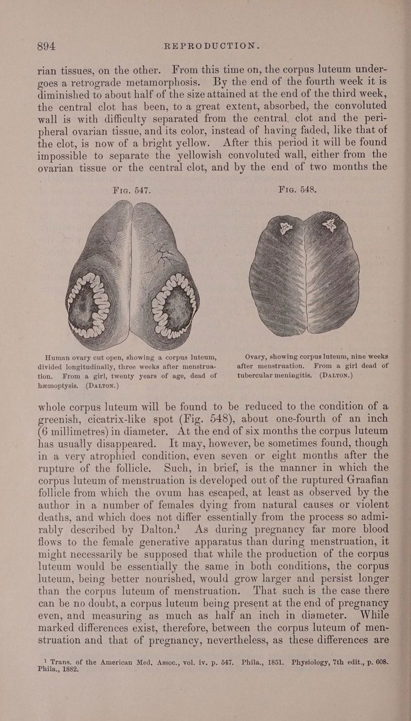 rian tissues, on the other. From this time on, the corpus luteum under- goes a retrograde metamorphosis. By the end of the fourth week it is diminished to about half of the size attained at the end of the third week, the central clot has been, to a great extent, absorbed, the convoluted wall is with difficulty separated from the central. clot and the peri- pheral ovarian tissue, and its color, instead of having faded, like that of the clot, is now of a bright yellow. After this period it will be found impossible to separate the yellowish convoluted wall, either from the ovarian tissue or the central clot, and by the end of two months the Human ovary cut open, showing a corpus luteum, Ovary, showing corpus luteum, nine weeks divided longitudinally, three weeks after menstrua- after menstruation. From a girl dead of tion. From a girl, twenty years of age, dead of tubercular meningitis. (Davron.) hemoptysis. (DaLTon.) whole corpus luteum will be found to be reduced to the condition of a greenish, cicatrix-like spot (Fig. 548), about one-fourth of an inch (6 millimetres) in diameter. At the end of six months the corpus luteum has usually disappeared. It may, however, be sometimes found, though in a very atrophied condition, even seven or eight months after the rupture of the follicle. Such, in brief, is the manner in which the corpus luteum of menstruation is developed out of the ruptured Graafian follicle from which the ovum has escaped, at least as observed by the author in a number of females dying from natural causes or violent deaths, and which does not differ essentially from the process so admi- rably described by Dalton.’ As during pregnancy far more blood flows to the female generative apparatus than during menstruation, it might necessarily be supposed that while the production of the corpus luteum would be essentially the same in both conditions, the corpus luteum, being better nourished, would grow larger and persist longer than the corpus luteum of menstruation. That such is the case there can be no doubt, a corpus luteum being present at the end of pregnancy even, and measuring as much as half an inch in diameter. While marked differences exist, therefore, between the corpus luteum of men- struation and that of pregnancy, nevertheless, as these differences are 1 Trans. of the American Med. Assoc., vol. iv. p. 547. Phila., 1851. Physiology, 7th edit., p. 608. Phila., 1882.