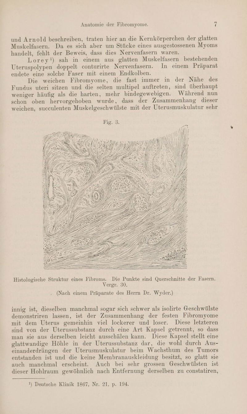 und Arnold beschreiben, traten hier an die Kernkörperchen der glatten Muskelfasern. Da es sich aber um Stücke eines ausgestossenen Myoms handelt, fehlt der Beweis, dass dies Nervenfasern waren. Lorey!) sah in einem aus glatten Muskelfasern bestehenden Uteruspolypen doppelt conturirte Nervenfasern. In einem Präparat endete eine solche Faser mit einem Endkolben. Die weichen Fibromyome, die fast immer in der Nähe des Fundus uteri sitzen und die selten multipel auftreten, sind überhaupt weniger häufig als die harten, mehr bindegewebigen. Während nun schon oben hervorgehoben wurde, dass der Zusammenhang dieser weichen, succulenten Muskelgeschwülste mit der Uterusmuskulatur sehr Pig. 2. ui Ki | NUTZ fl Ni MHNNH) \ N \ \ BR HG Hl )) m  N] ı\ INN iM HIN FEIERN N \ IN 1, AN € WW JENS \\!) Mi; IM \NN Histologische Struktur eines Fibroms. Die Punkte sind Querschnitte der Fasern. Vergr. 30. (Nach einem Präparate des Herrn Dr. Wyder.) innig ist, dieselben manchmal sogar sich schwer als isolirte Geschwülste demonstriren lassen, ist der Zusammenhang der festen Fibromyome mit dem Uterus gemeinhin viel lockerer und loser. Diese letzteren sind von der Uterussubstanz durch eine Art Kapsel getrennt, so dass man sie aus derselben leicht ausschälen kann. Diese Kapsel stellt eine glattwandige Höhle in der Uterussubstanz dar, die wohl durch Aus- einanderdrängen der Uterusmuskulatur beim Wachsthum des Tumors entstanden ist und die keine Membranauskleidung besitzt, so glatt sie auch manchmal erscheint. Auch bei sehr grossen Geschwülsten ist dieser Hohlraum gewöhnlich nach Entfernung derselben zu constatiren, !) Deutsche Klinik 1867, Nr. 21, p. 194.