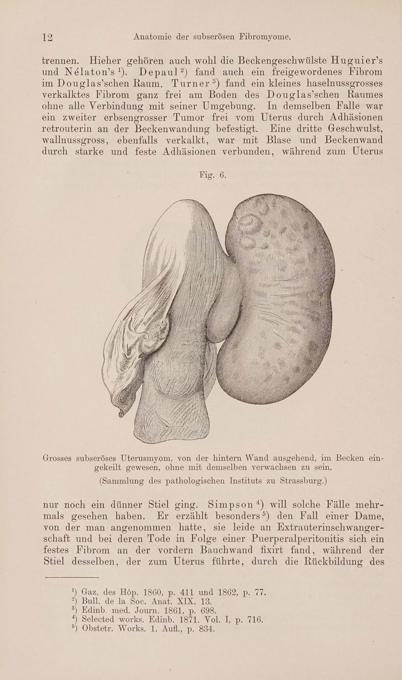 trennen. Hieher gehören auch wohl die Beckengeschwülste Huguier’s und Nelaton’s!). Depaul?) fand auch ein freigewordenes Fibrom im Douglas’schen Raum. Turner) fand ein kleines haselnussgrosses verkalktes Fibrom ganz frei am Boden des Douglas’schen Raumes ohne alle Verbindung mit seiner Umgebung. In demselben Falle war ein zweiter erbsengrosser Tumor frei vom Uterus durch Adhäsionen retrouterin an der Beckenwandung befestigt. Eine dritte Geschwulst, wallnussgross, ebenfalls verkalkt, war mit Blase und Beckenwand durch starke und feste Adhäsionen verbunden, während zum Uterus ans S ET Be S S a AT I ES SS = SS SS RUSS \ IS = = Re I = Ni S = - er — = >> Se Grosses subseröses Uterusmyom, von der hintern Wand ausgehend, im Becken ein- gekeilt gewesen, ohne mit demselben verwachsen zu sein. (Sammlung des pathologischen Instituts zu Strassburg.) nur noch ein dünner Stiel ging. Simpson *) will solche Fälle mehr- mals gesehen haben. Er erzählt besonders?) den Fall einer Dame, von der man angenommen hatte, sie leide an Extrauterinschwanger- schaft und bei deren Tode in Folge einer Puerperalperitonitis sich ein festes Fibrom an der vordern Bauchwand fixirt fand, während der Stiel desselben, der zum Uterus führte, durch die Rückbildung des !) Gaz. des Höp. 1860, p. 411 und 1862, p. 77. ), Bull..de la 806. AyanıX IX, a Selected works. Edinb. 1871. Vol. I, p. 716. °) Obstetr. Works. 1. Aufl., p. 834. w