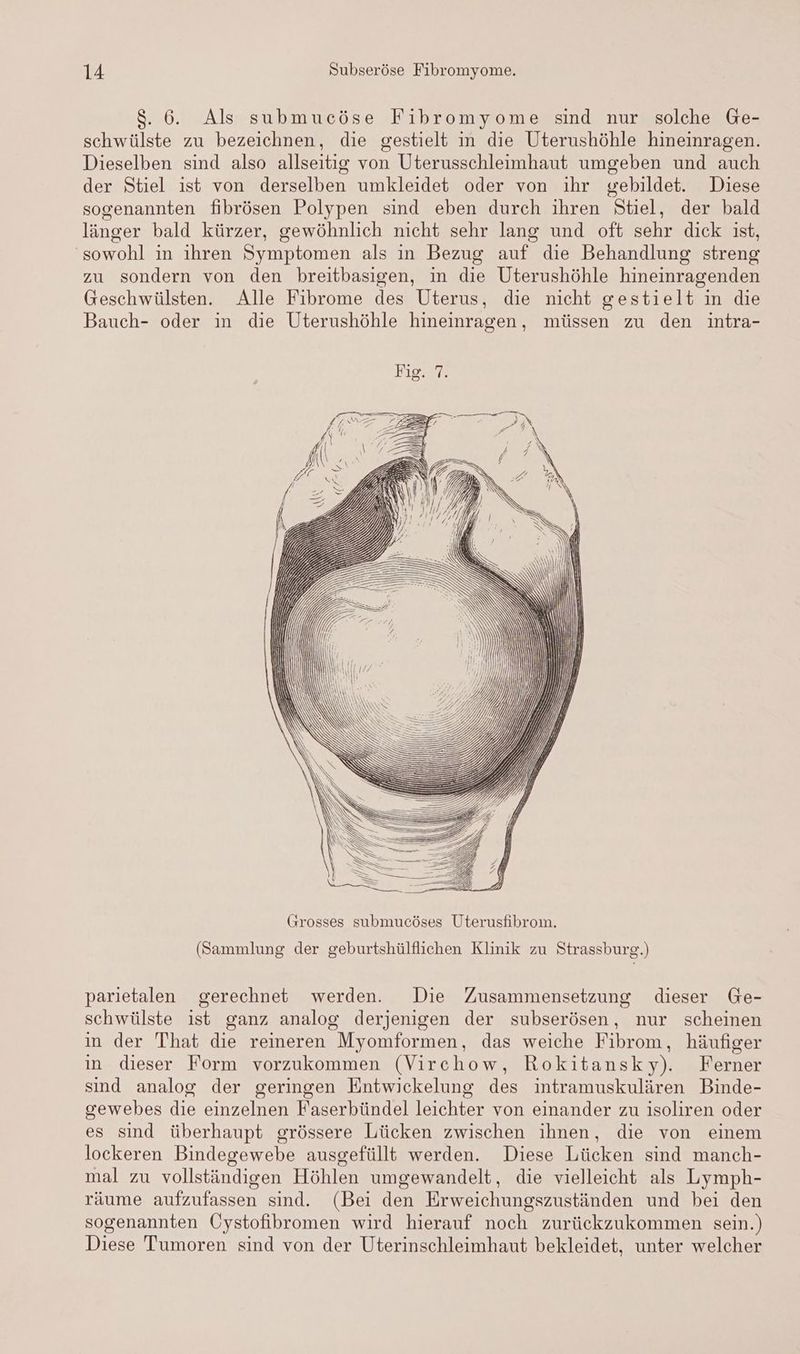 8.6. Als submucöse Fibromyome sind nur solche Ge- schwülste zu bezeichnen, die gestielt in die Uterushöhle hineinragen. Dieselben sind also allseitig von Uterusschleimhaut umgeben und auch der Stiel ist von derselben umkleidet oder von ihr «ebildet. Diese sogenannten fibrösen Polypen sind eben durch ihren Stiel, der bald länger bald kürzer, gewöhnlich nicht sehr lang und oft sehr dick ist, ‘sowohl in ihren Symptomen als in Bezug auf die Behandlung streng zu sondern von den breitbasigen, in die Üterushöhle hineinragenden Geschwülsten. Alle Fibrome des Uterus, die nicht gestielt in die Bauch- oder in die Uterushöhle hineinragen, müssen zu den intra- (Sammlung der geburtshülflichen Klinik zu Strassburg.) parietalen gerechnet werden. Die Zusammensetzung dieser Ge- schwülste ist ganz analog derjenigen der subserösen, nur scheinen in der That die reineren Myomformen, das weiche Fibrom, häufiger in dieser Form vorzukommen (Virchow, Rokitansky). Ferner sind analog der geringen Entwickelung des intramuskulären Binde- gewebes die einzelnen Faserbündel leichter von einander zu isoliren oder es sind überhaupt grössere Lücken zwischen ihnen, die von einem lockeren Bindegewebe ausgefüllt werden. Diese Lücken sind manch- mal zu vollständigen Höhlen umgewandelt, die vielleicht als Lymph- räume aufzufassen sind. (Bei den Erweichungszuständen und bei den sogenannten Öystofibromen wird hierauf noch zurückzukommen sein.) Diese Tumoren sind von der Uterinschleimhaut bekleidet, unter welcher