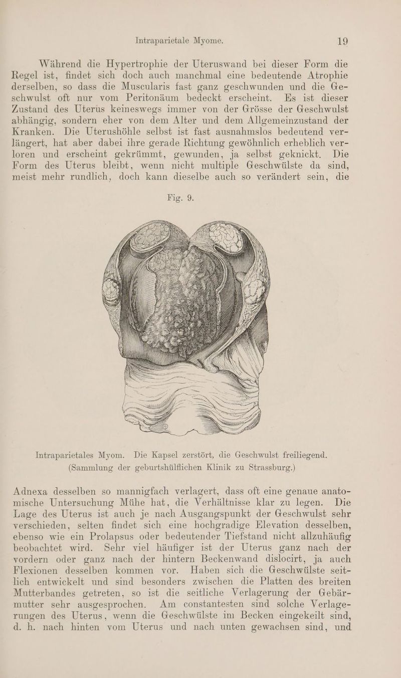 Während die Hypertrophie der Uteruswand bei dieser Form die Regel ist, findet sich doch auch manchmal eine bedeutende Atrophie derselben, so dass die Muscularis fast ganz geschwunden und die Ge- schwulst oft nur vom Peritonäum bedeckt erscheint. Es ist dieser Zustand des Uterus keineswegs immer von der Grösse der Geschwulst abhängig, sondern eher von dem Alter und dem Alloemeinzustand der Kranken. Die Uterushöhle selbst ist fast ausnahmslos bedeutend ver- längert, hat aber dabei ihre gerade Richtung gewöhnlich erheblich ver- loren und erscheint gekrümmt, gewunden, ja selbst geknickt. Die Form des Uterus bleibt, wenn nicht multiple Geschwülste da sind, meist mehr rundlich, doch kann dieselbe auch so verändert sein, die Intraparietales Myom. Die Kapsel zerstört, die Geschwulst freiliegend. (Sammlung der geburtshülflichen Klinik zu Strassburg.) Adnexa desselben so mannigfach verlagert, dass oft eine genaue anato- mische Untersuchung Mühe hat, die Verhältnisse klar zu legen. Die Lage des Uterus ist auch je nach Ausgangspunkt der Geschwulst sehr verschieden, selten findet sich eine hochgradige Elevation desselben, ebenso wie ein Prolapsus oder bedeutender 'Tiefstand nicht allzuhäufig beobachtet wird. Sehr viel häufiger ist der Uterus ganz nach der vordern oder ganz nach der hintern Beckenwand dislocirt, ja auch Flexionen desselben kommen vor. Haben sich die Geschwülste seit- lich entwickelt und sind besonders zwischen die Platten des breiten Mutterbandes getreten, so ist die seitliche Verlagerung der Gebär- mutter sehr ausgesprochen. Am constantesten sind solche Verlage- rungen des Uterus, wenn die Geschwülste im Becken eingekeilt sind, d. h. nach hinten vom Uterus und nach unten gewachsen sind, und