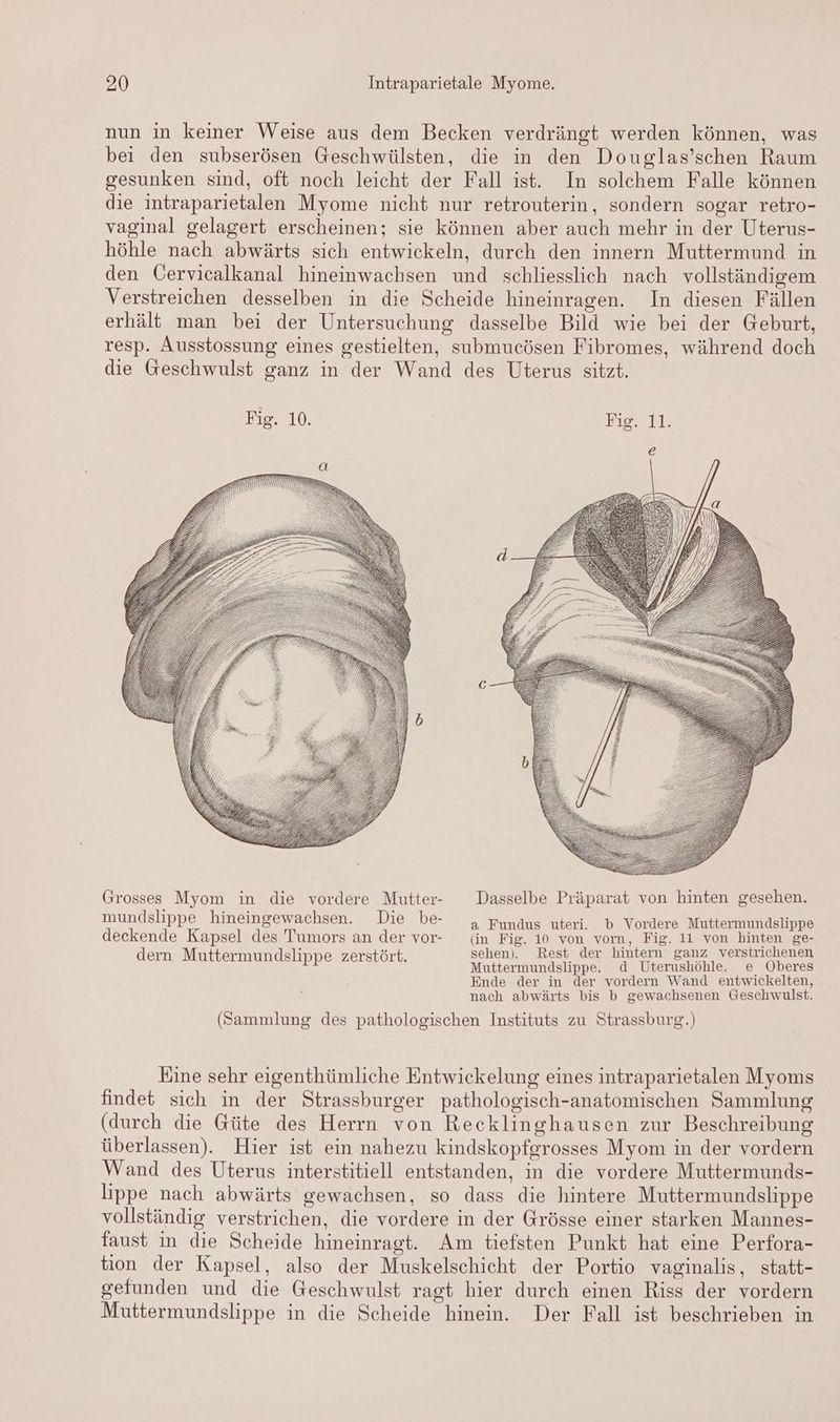 nun in keiner Weise aus dem Becken verdrängt werden können, was bei den subserösen Geschwülsten, die in den Douglas’schen Raum gesunken sind, oft noch leicht der Fall ist. In solchem Falle können die intraparietalen Myome nicht nur retrouterin, sondern sogar retro- vaginal gelagert erscheinen; sie können aber auch mehr in der Uterus- höhle nach abwärts sich entwickeln, durch den innern Muttermund in den Cervicalkanal hineinwachsen und schliesslich nach vollständigem Verstreichen desselben in die Scheide hineinragen. In diesen Fällen erhält man bei der Untersuchung dasselbe Bild wie bei der Geburt, resp. Ausstossung eines gestielten, submucösen Fibromes, während doch die Geschwulst ganz in der Wand des Uterus sitzt. Fig. 10. D>* BE TITTR Grosses Myom in die vordere Mutter- Dasselbe Präparat von hinten gesehen. mundslippe hineingewachsen. Die be- „ Fundus uteri. b Vordere Muttermundslippe deckende Kapsel des Tumors an der vor- (in Fig. 10 von vom, Fig. 11 von hinten ge- sehen). Rest der hintern ganz verstrichenen I nn ne au Muttermundslippe. d Uterushöhle. e Oberes Ende der in der vordern Wand entwickelten, nach abwärts bis b gewachsenen Geschwulst. (Sammlung des pathologischen Instituts zu Strassburg.) Eine sehr eigenthümliche Entwickelung eines intraparietalen Myoms findet sich in der Strassburger pathologisch-anatomischen Sammlung (durch die Güte des Herrn von Recklinghausen zur Beschreibung überlassen). Hier ist ein nahezu kindskopfgrosses Myom in der vordern Wand des Uterus interstitiell entstanden, in die vordere Muttermunds- lippe nach abwärts gewachsen, so dass die hintere Muttermundslippe vollständig verstrichen, die vordere in der Grösse einer starken Mannes- faust in die Scheide hineinragt. Am tiefsten Punkt hat eine Perfora- tion der Kapsel, also der Muskelschicht der Portio vaginalis, statt- gefunden und die Geschwulst ragt hier durch einen Riss der vordern Muttermundslippe in die Scheide hinein. Der Fall ist beschrieben in