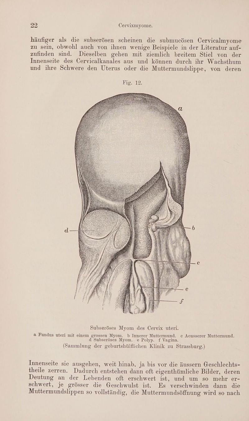 häufiger als die subserösen scheinen die submucösen Cervicalmyome zu sein, obwohl auch von ihnen wenige Beispiele in der Literatur auf- zufinden sind. Dieselben gehen mit ziemlich breitem Stiel von der Innenseite des Cervicalkanales aus und können durch ihr Wachsthum und ihre Schwere den Uterus oder die Muttermundslippe, von deren AI, N I en ) DNIKER, GE: —F: e—— QII=n l A | N 1 ıW | ı) Yl a \ RN 777 ANıs? 7 ik! l |) „ N In N | Subseröses Myom des Cervix uteri. a Fundus uteri mit einem grossen Myom. b Innerer Muttermund. c Aeusserer Muttermund. d Subseröses Myom. e Polyp. f Vagina. (Sammlung der geburtshülflichen Klinik zu Strassburg.) Innenseite sie ausgehen, weit hinab, ja bis vor die äussern Geschlechts- theile zerren. Dadurch entstehen dann oft eigenthümliche Bilder, deren Deutung an der Lebenden oft erschwert ist, und um so mehr er- schwert, je grösser die Geschwulst ist. Es verschwinden dann die Muttermundslippen so vollständig, die Muttermundsöffnung wird so nach