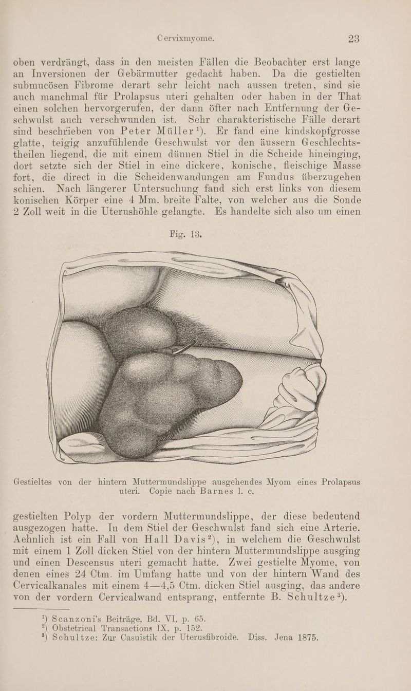 oben verdrängt, dass in den meisten Fällen die Beobachter erst lange an Inversionen der Gebärmutter gedacht haben. Da die gestielten submucösen Fibrome derart sehr leicht nach aussen treten, sind sie auch manchmal für Prolapsus uteri gehalten oder haben in der That einen solchen hervorgerufen, der dann öfter nach Entfernung der Ge- schwulst auch verschwunden ist. Sehr charakteristische Fälle derart sind beschrieben von Peter Müller!). Er fand eine kindskopfgrosse glatte, teigig anzufühlende Geschwulst vor den äussern Geschlechts- theilen liegend, die mit einem dünnen Stiel in die Scheide hineinging, dort setzte sich der Stiel in eine dickere, konische, fleischige Masse fort, die direct in die Scheidenwandungen am Fundus überzugehen schien. Nach längerer Untersuchung fand sich erst links von diesem konischen Körper eine 4 Mm. breite Falte, von welcher aus die Sonde 2 Zoll weit in die Uterushöhle gelangte. Es handelte sich also um einen (Gestieltes von der hintern Muttermundslippe ausgehendes Myom eines Prolapsus uteri. Copie nach Barnes. c. gestielten Polyp der vordern Muttermundslippe, der diese bedeutend ausgezogen hatte. In dem Stiel der Geschwulst fand sich eine Arterie. Aehnlich ist ein Fall von Hall Davis?), in welchem die Geschwulst mit einem 1 Zoll dicken Stiel von der hintern Muttermundslippe ausging und einen Descensus uteri gemacht hatte. Zwei gestielte Myome, von denen eines 24 Otm. im Umfang hatte und von der hintern Wand des Cervicalkanales mit einem 4—4,5 Ötm. dicken Stiel ausging, das andere von der vordern Cervicalwand entsprang, entfernte B. Schultze°). !) Scanzoni’s Beiträge, Bd. VI, p. 65. *”) Obstetrical Transactions IX, p. 152. ®) Schultze: Zur Casuistik der Uterusfibroide. Diss. Jena 1875.