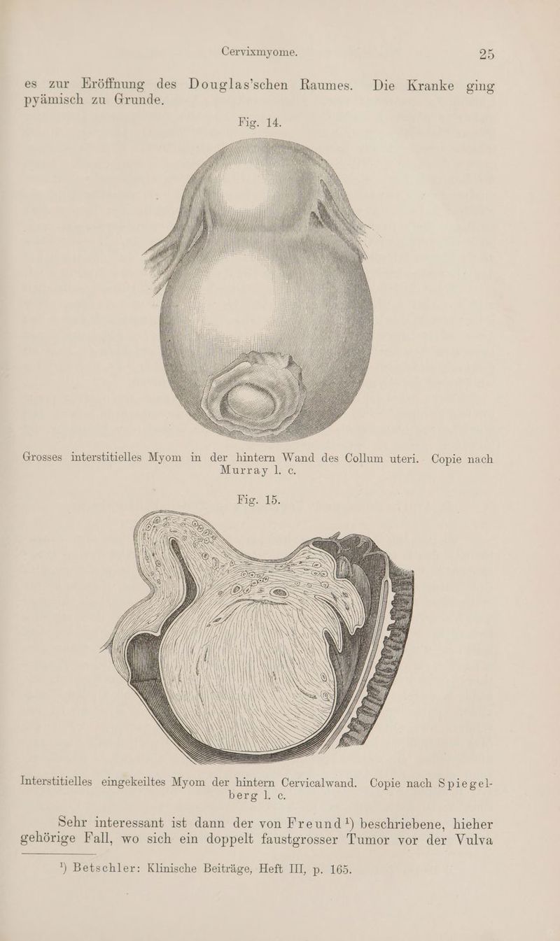 es zur Eröffnung des Douglas’schen Raumes. Die Kranke ging pyämisch zu Grunde. Grosses interstitielles Myom in der hintern Wand des Collum uteri. Copie nach Murray l; € Interstitielles eingekeiltes Myom der hintern Cervicalwand. Copie nach Spiegel- berg l. c. Sehr interessant ist dann der von Freund!) beschriebene, hieher gehörige Fall, wo sich ein doppelt faustgrosser Tumor vor der Vulva ‘) Betschler: Klinische Beiträge, Heft II, p. 165.