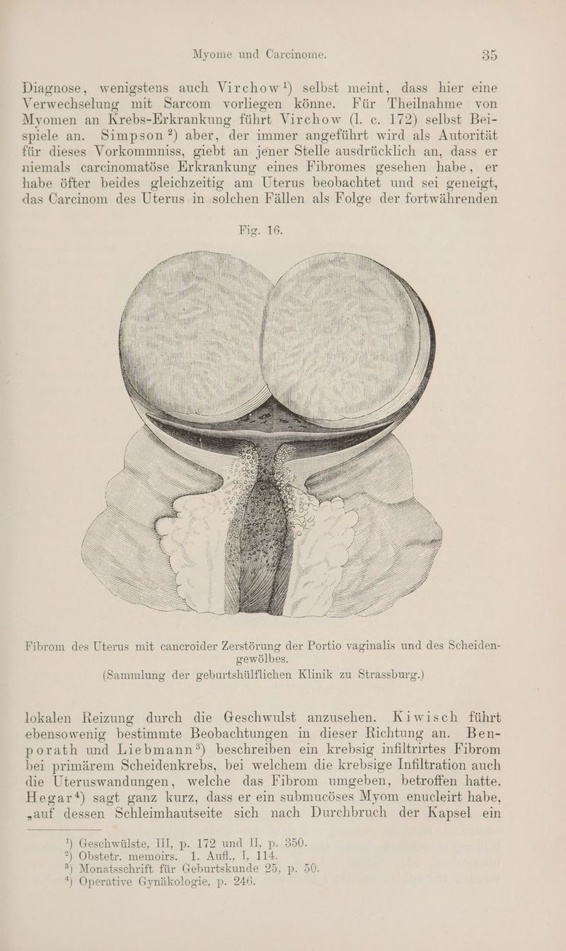 Diagnose, wenigstens auch Virchow!) selbst meint, dass hier eine Verwechselung mit Sareom vorliegen könne. Für Theilnahme von Myomen an Krebs-Erkrankung führt Virchow (l. c. 172) selbst Bei- spiele an. Simpson?) aber, der immer angeführt wird als Autorität für dieses Vorkommniss, giebt an jener Stelle ausdrücklich an, dass er niemals carcinomatöse Erkrankung eines Fibromes gesehen habe, er habe öfter beides gleichzeitig am Uterus beobachtet und sei geneigt, das Carcinom des Uterus in solchen Fällen als Folge der fortwährenden Fibrom des Uterus mit cancroider Zerstörung der Portio vaginalis und des Scheiden- gewölbes. (Sammlung der geburtshülflichen Klinik zu Strassburg.) lokalen Reizung durch die Geschwulst anzusehen. Kıwisch führt ebensowenig bestimmte Beobachtungen in dieser Richtung an. Ben- porath und Liebmann°) beschreiben ein krebsig infiltrirtes Fibrom bei primärem Scheidenkrebs, bei welchem die krebsige Infiltration auch die Uteruswandungen, welche das Fibrom umgeben, betroffen hatte. Hegart) sagt ganz kurz, dass er ein submucöses Myom enucleirt habe, „auf dessen Schleimhautseite sich nach Durchbruch der Kapsel ein 2) Ekerälkte, 41». 1472 und .]],. P::880. ?) Obstetr. memoirs. 1. Aufl., I, 114. ) ) w Monatsschrift für Geburtskunde 233, D. u0: Operative Gynäkologie, p. 246. 4