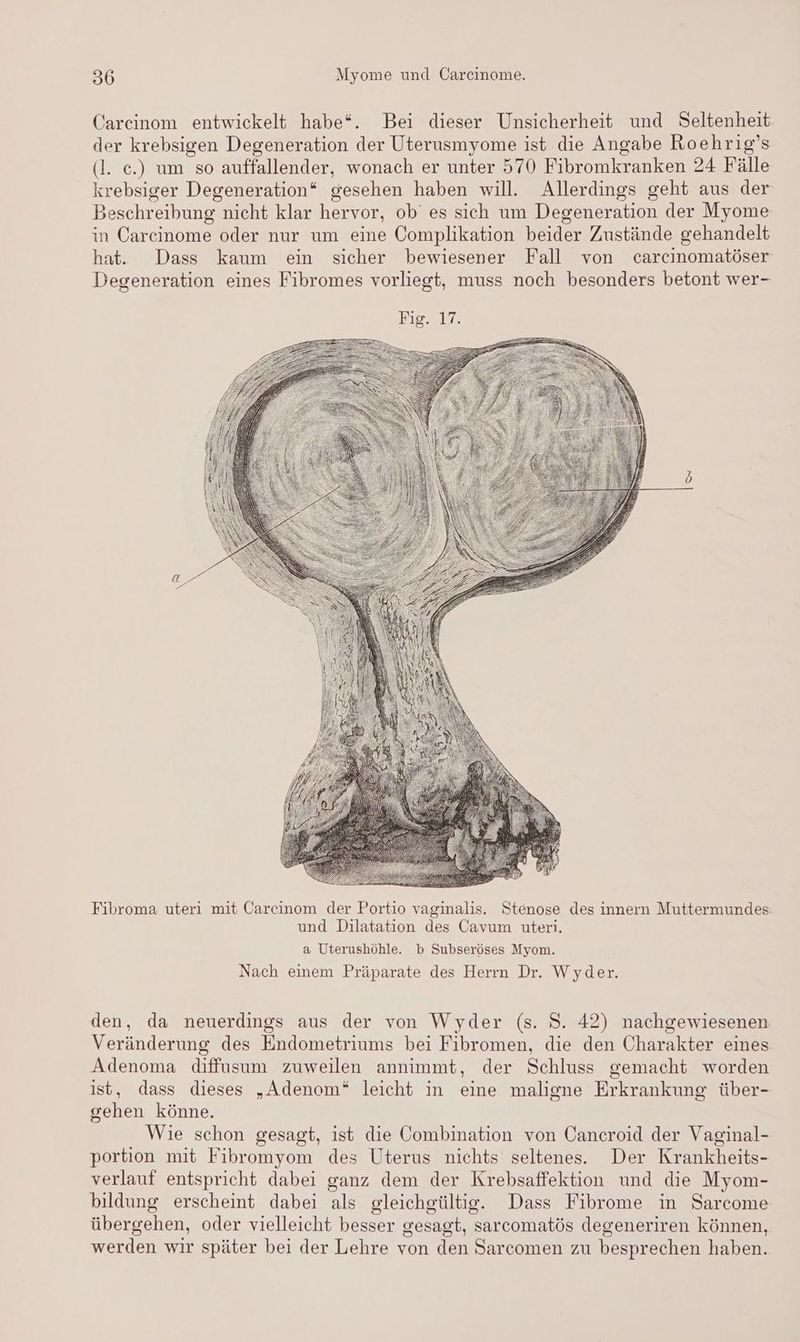 Carcinom entwickelt habe“. Bei dieser Unsicherheit und Seltenheit der krebsigen Degeneration der Uterusmyome ist die Angabe Roehrig’s (l. ec.) um so auffallender, wonach er unter 570 Fibromkranken 24 Fälle krebsiger Degeneration“ gesehen haben will. Allerdings geht aus der Beschreibung nicht klar hervor, ob es sich um Degeneration der Myome in Carcinome oder nur um eine Complikation beider Zustände gehandelt hat. Dass kaum ein sicher bewiesener Fall von carcinomatöser Degeneration eines Fibromes vorliegt, muss noch besonders betont wer- Fibroma uteri mit Carcinom der Portio vaginalis. Stenose des innern Muttermundes: und Dilatation des Cavum uteri. a Uterushöhle. b Subseröses Myom. Nach einem Präparate des Herrn Dr. Wyder. den, da neuerdings aus der von Wyder (s. S. 42) nachgewiesenen Veränderung des Endometriums bei Fibromen, die den Charakter eines Adenoma diffusum zuweilen annimmt, der Schluss gemacht worden ist, dass dieses „Adenom“ leicht in eine maligne Erkrankung über- gehen könne. Wie schon gesagt, ist die Combination von Cancroid der Vagimal- portion mit Fibromyom des Uterus nichts seltenes. Der Krankheits- verlauf entspricht dabei ganz dem der Krebsaffektion und die Myom- bildung erscheint dabei als gleichgültig. Dass Fibrome in Sarcome übergehen, oder vielleicht besser gesagt, sarcomatös degeneriren können, werden wir später bei der Lehre von den Sarcomen zu besprechen haben.
