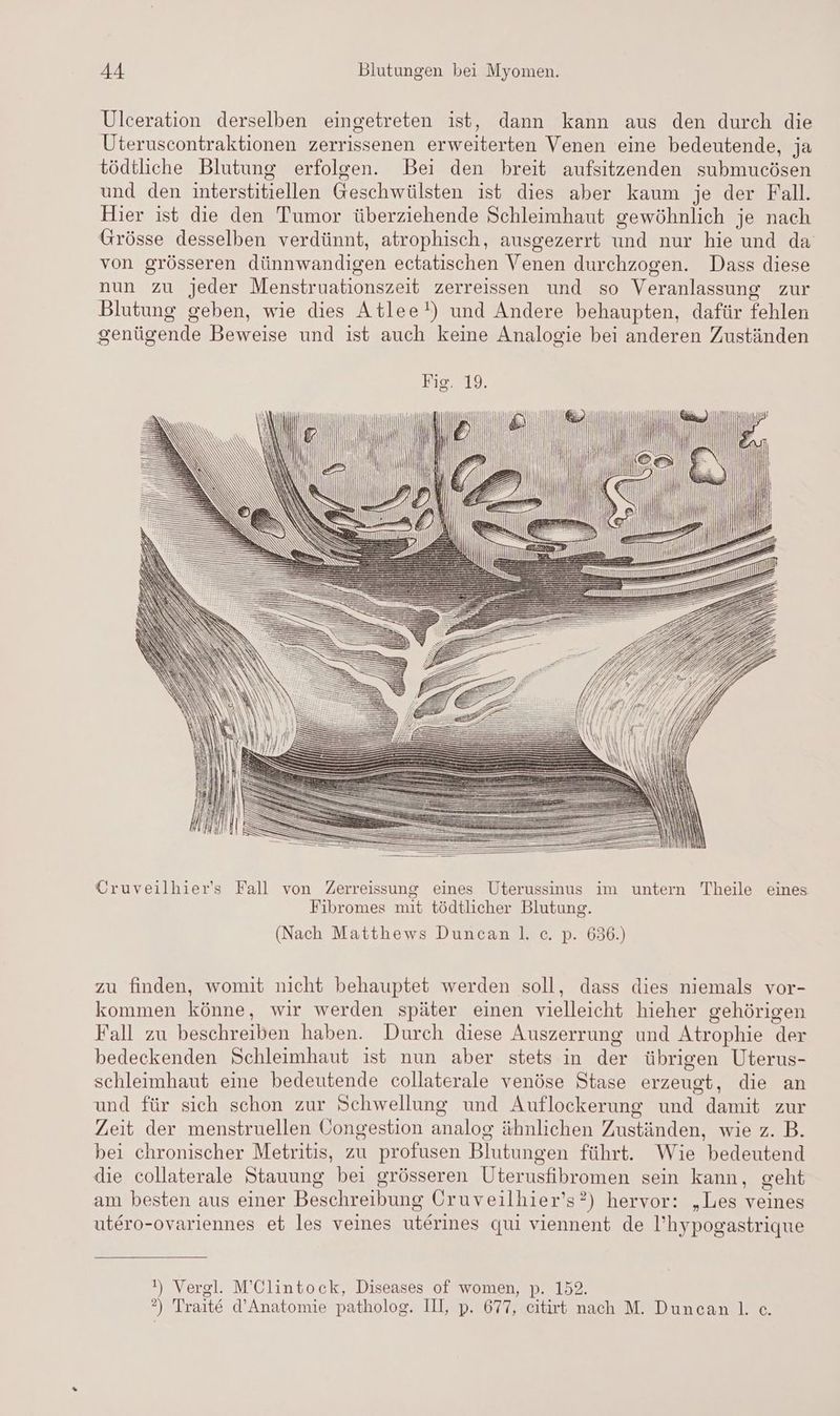 Ulceration derselben eingetreten ist, dann kann aus den durch die Uteruscontraktionen zerrissenen erweiterten Venen eine bedeutende, ja tödtliche Blutung erfolgen. Bei den breit aufsitzenden submucösen und den interstitiellen Geschwülsten ist dies aber kaum je der Fall. Hier ist die den Tumor überziehende Schleimhaut gewöhnlich je nach Grösse desselben verdünnt, atrophisch, ausgezerrt und nur hie und da von grösseren dünnwandigen ectatischen Venen durchzogen. Dass diese nun zu jeder Menstruationszeit zerreissen und so Veranlassung zur Blutung geben, wie dies Atlee!) und Andere behaupten, dafür fehlen genügende Beweise und ist auch keine Analogie bei anderen Zuständen Cruveilhier's Fall von Zerreissung eines Uterussinus im untern Theile eines Fibromes mit tödtlicher Blutung. (Nach Matthews Duncan |. c. p. 636.) zu finden, womit nicht behauptet werden soll, dass dies niemals vor- kommen könne, wir werden später einen vielleicht hieher gehörigen Fall zu beschreiben haben. Durch diese Auszerrung und Atrophie der bedeckenden Schleimhaut ist nun aber stets in der übrigen Uterus- schleimhaut eine bedeutende collaterale venöse Stase erzeugt, die an und für sich schon zur Schwellung und Auflockerung und damit zur Zeit der menstruellen Öongestion analog ähnlichen Zuständen, wie z. B. bei chronischer Metritis, zu profusen Blutungen führt. Wie bedeutend die collaterale Stauung bei grösseren Uterusfibromen sein kann, geht am besten aus einer Beschreibung Cruveilhier’s?) hervor: „Les veines utero-ovariennes et les veines uterines qui viennent de l’hypogastrique !) Vergl. M’Clintock, Diseases of women, p. 152. ?) Traite d’Anatomie patholog. III, p. 677, eitirt nach M. Duncan. c.