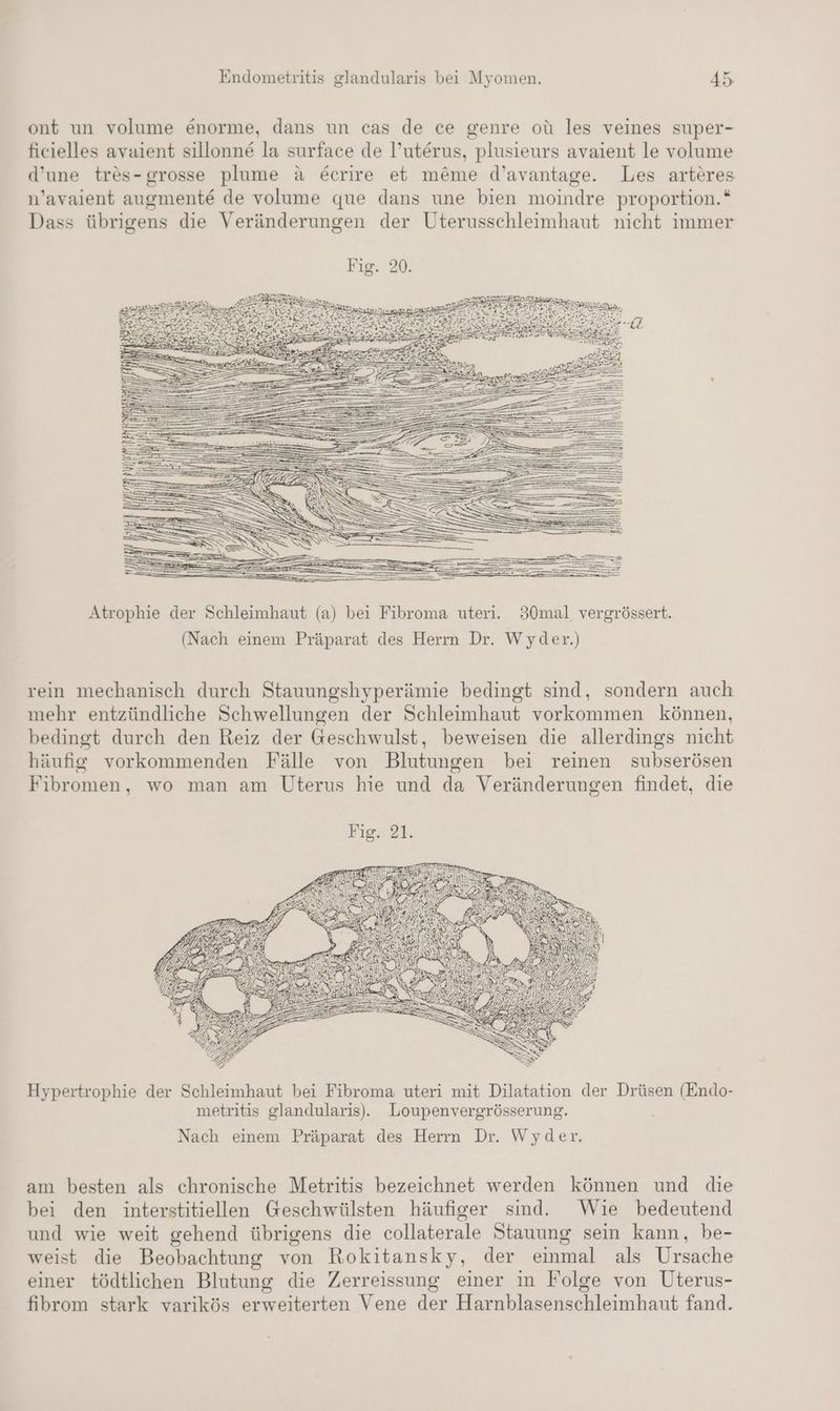 ont un volume enorme, dans un cas de ce genre oü les veines super- ficielles avaient sillonn& la surface de l’uterus, plusieurs avaient le volume d’une tres-grosse plume a €crire et me&me d’avantage. Les arteres n’avaient augmente de volume que dans une bien moindre proportion.* Dass übrigens die Veränderungen der Uterusschleimhaut nicht immer Fig. 20. sr rer . EN TER S RESTRIGE gr RE I 2 RS Atrophie der Schleimhaut (a) bei Fibroma uteri. 30mal vergrössert. (Nach einem Präparat des Herrn Dr. Wyder.) rein mechanisch durch Stauungshyperämie bedingt sind, sondern auch mehr entzündliche Schwellungen der Schleimhaut vorkommen können, bedingt durch den Reiz der Geschwulst, beweisen die allerdings nicht häufig vorkommenden Fälle von Blutungen bei reinen subserösen Fibromen, wo man am Uterus hie und da Veränderungen findet, die Fig,'3L. Hypertrophie der Schleimhaut bei Fibroma uteri mit Dilatation der Drüsen (Endo- metritis glandularis).. Loupenvergrösserung. Nach einem Präparat des Herrn Dr. Wyder. am besten als chronische Metritis bezeichnet werden können und die bei den interstitiellen Geschwülsten häufiger sind. Wie bedeutend und wie weit gehend übrigens die collaterale Stauung sein kann, be- weist die Beobachtung von Rokitansky, der einmal als Ursache einer tödtlichen Blutung die Zerreissung einer ım Folge von Uterus- fibrom stark varikös erweiterten Vene der Harnblasenschleimhaut fand.
