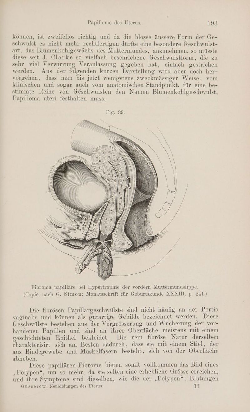 können, ist zweifellos richtig und da die blosse äussere Form der Ge- schwulst es nicht mehr rechtfertigen dürfte eine besondere Geschwulst- art, das Blumenkohlgewächs des Muttermundes, anzunehmen, so müsste diese seit J. Clarke so vielfach beschriebene Geschwulstform, die zu sehr viel Verwirrung Veranlassung gegeben hat, einfach gestrichen werden. Aus der folgenden kurzen Darstellung wird aber doch her- vorgehen, dass man bis jetzt wenigstens zweckmässiger Weise, vom klinischen und sogar auch vom anatomischen Standpunkt, für eine be- stimmte Reihe von Geschwülsten den Namen Blumenkohlgeschwulst, Papilloma uteri festhalten muss. I N \ SD N IR -, INN VAN IN AN N EEROIITN Fibroma papillare bei Hypertrophie der vordern Muttermundslippe. (Copie nach G. Simon: Monatsschrift für Geburtskunde XXXII, p. 241.) Die fibrösen Papillargeschwülste sind nicht häufig an der Portio vaginalis und können als gutartige Gebilde bezeichnet werden. Diese Geschwülste bestehen aus der Vergrösserung und Wucherung der vor- handenen Papillen und sind an ihrer Oberfläche meistens mit einem geschichteten Epithel bekleidet. Die rein fibröse Natur derselben charakterisirt sich am Besten dadurch, dass sie mit einem Stiel, der aus Bindegewebe und Muskelfasern besteht, sich von der Oberfläche abheben. a Diese papillären Fibrome bieten somit vollkommen das Bild eines „Polypen‘, um so mehr, da sie selten eine erhebliche Grösse erreichen, und ihre Symptome sind dieselben, wie die der „Polypen“: Blutungen Gusserow, Neubildungen des Uterus. 13
