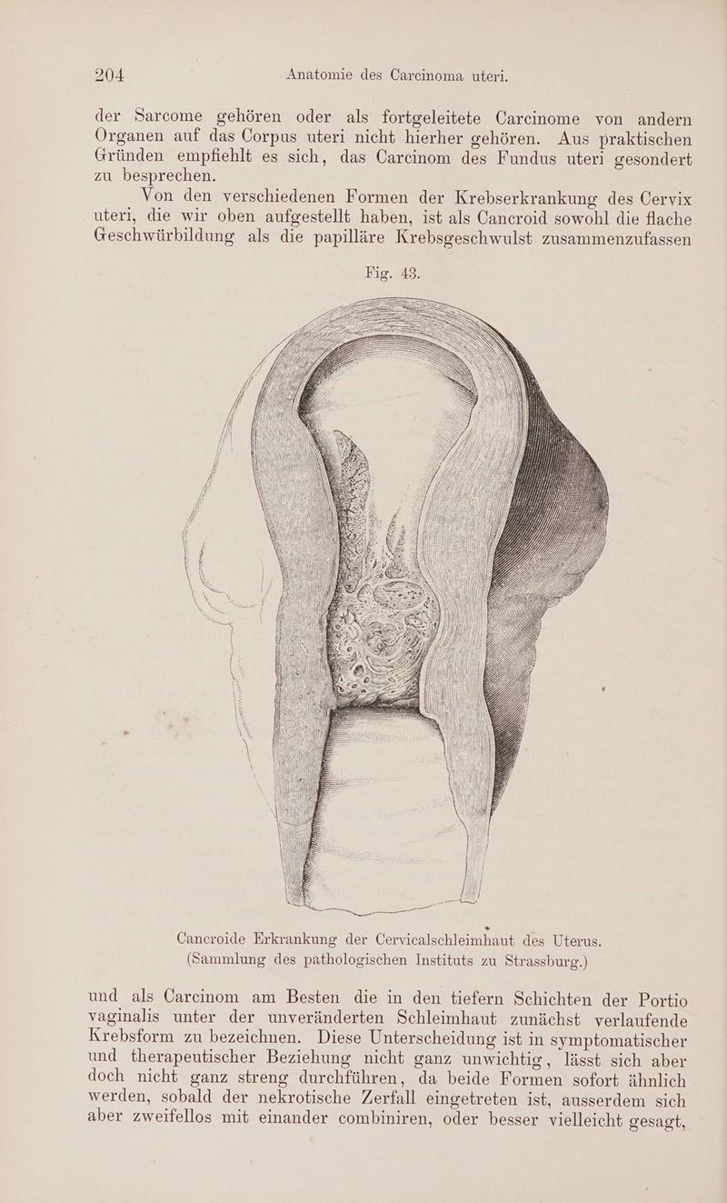 der Sarcome gehören oder als fortgeleitete Carcinome von andern Organen auf das Corpus uteri nicht hierher gehören. Aus praktischen Gründen empfiehlt es sich, das Carcinom des Fundus uteri gesondert zu besprechen. Von den verschiedenen Formen der Krebserkrankung des Cervix uterl, die wir oben aufgestellt haben, ist als Cancroid sowohl die flache Geschwürbildung als die papilläre Krebsgeschwulst zusammenzufassen Cancroide Erkrankung der Cervicalschleimhaut des Uterus. (Sammlung des pathologischen Instituts zu Strassburg.) und als Carcinom am Besten die in den tiefern Schichten der Portio vaginalis unter der unveränderten Schleimhaut zunächst verlaufende Krebsform zu bezeichnen. Diese Unterscheidung ist in symptomatischer und therapeutischer Beziehung nicht ganz unwichtig, lässt sich aber doch nicht ganz streng durchführen, da beide Formen sofort ähnlich werden, sobald der nekrotische Zerfall eingetreten ist, ausserdem sich aber zweifellos mit einander combiniren, oder besser vielleicht gesagt,