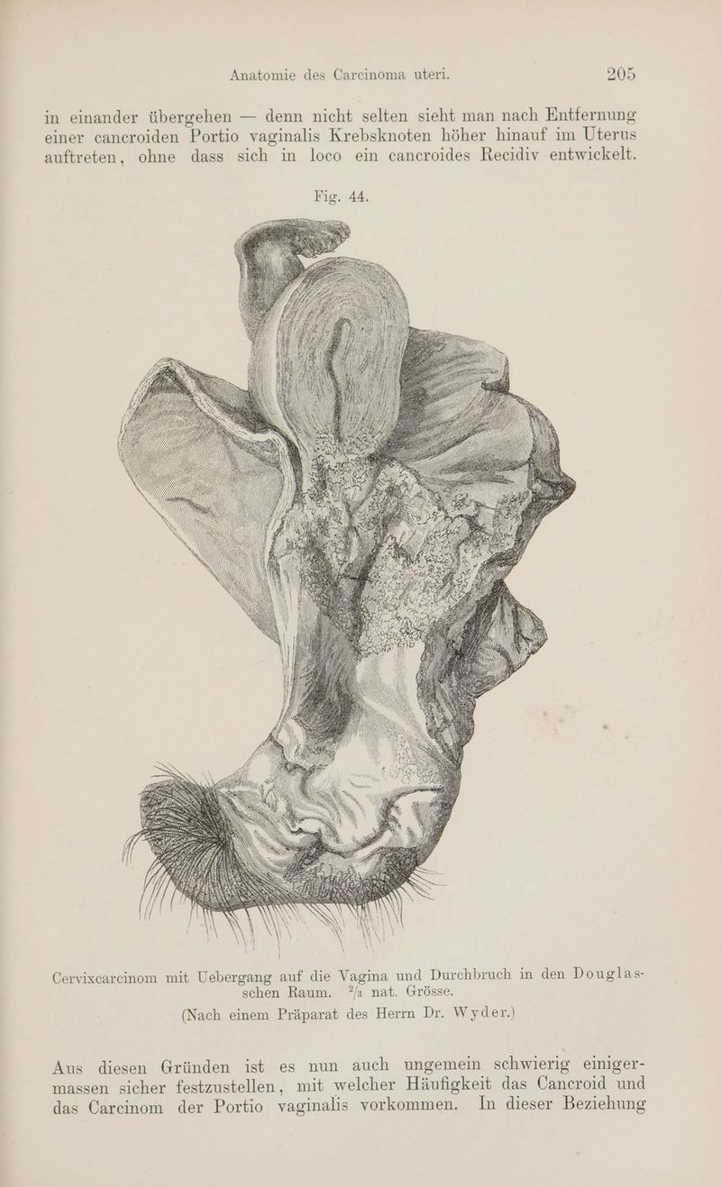 in einander übergehen — denn nicht selten sieht man nach Entfernung einer cancroiden Portio vaginalis Krebsknoten höher hinauf im Uterus auftreten, ohne dass sich in loco ein cancroides Recidiv entwickelt. Fig. 44. Cervixcareinom mit Uebergang auf die Vagina und Durchbruch in den Douglas- schen Raum. ?/ nat. Grösse. (Nach einem Präparat des Herrn Dr. Wyder.) Aus diesen Gründen ist es nun auch ungemein schwierig einiger- massen sicher festzustellen, mit welcher Häufigkeit das Caneroid und das Carcinom der Portio vaginalis vorkommen. In dieser Beziehung