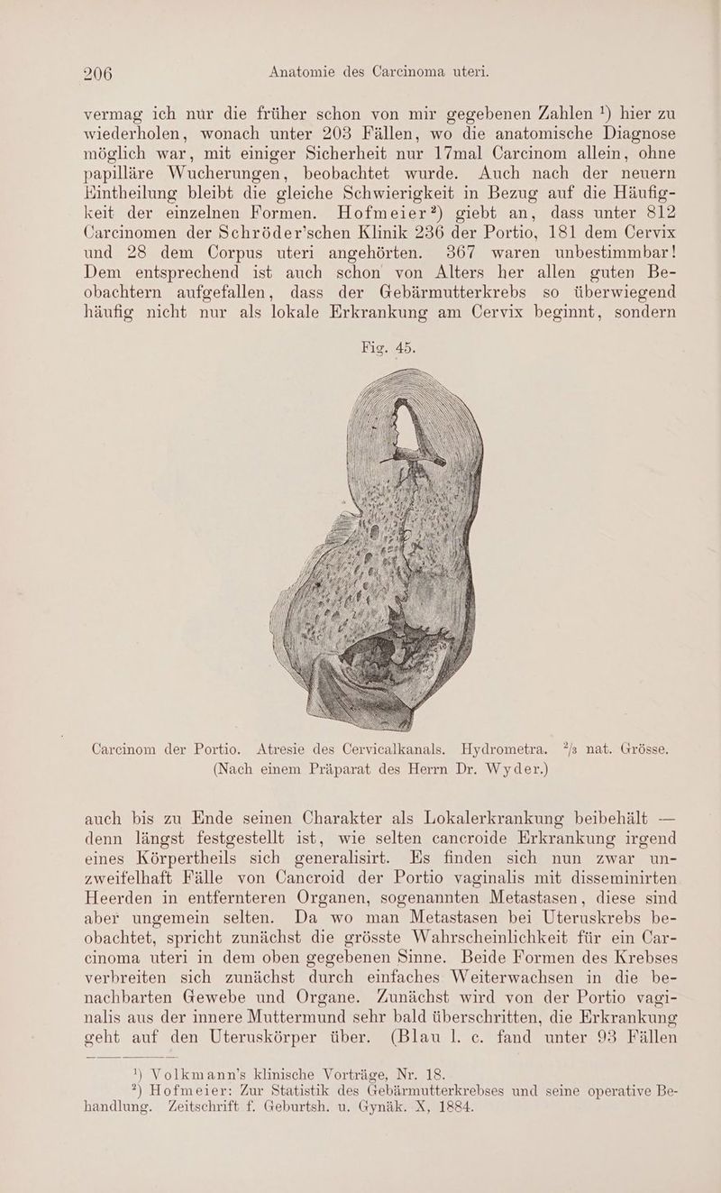 N vermag ich nur die früher schon von mir gegebenen Zahlen !) hier zu wiederholen, wonach unter 203 Fällen, wo die anatomische Diagnose möglich war, mit einiger Sicherheit nur 17mal Carcinom allein, ohne papilläre Wucherungen, beobachtet wurde. Auch nach der neuern Eintheilung bleibt die gleiche Schwierigkeit in Bezug auf die Häufig- keit der einzelnen Formen. Hofmeier?) giebt an, dass unter 812 Uarecinomen der Schröder’schen Klinik 236 der Portio, 181 dem Cervix und 28 dem Corpus uteri angehörten. 367 waren unbestimmbar! Dem entsprechend ist auch schon von Alters her allen guten Be- obachtern aufgefallen, dass der Gebärmutterkrebs so überwiegend häufig nicht nur als lokale Erkrankung am Üervix beginnt, sondern Carcinom der Portio. Atresie des Cervicalkanals. Hydrometra. */s nat. Grösse. (Nach einem Präparat des Herrn Dr. Wyder.) auch bis zu Ende seinen Charakter als Lokalerkrankung beibehält — denn längst festgestellt ist, wie selten cancroide Erkrankung irgend eines Körpertheils sich generalisirt. Es finden sich nun zwar un- zweifelhaft Fälle von Cancroid der Portio vaginalis mit disseminirten Heerden in entfernteren Organen, sogenannten Metastasen, diese sind aber ungemein selten. Da wo man Metastasen bei Uteruskrebs be- obachtet, spricht zunächst die grösste Wahrscheinlichkeit für ein Car- cinoma uteri in dem oben gegebenen Sinne. Beide Formen des Krebses verbreiten sich zunächst durch einfaches Weiterwachsen in die be- nachbarten Gewebe und Organe. Zunächst wird von der Portio vagi- nalis aus der innere Muttermund sehr bald überschritten, die Erkrankung geht auf den Uteruskörper über. (Blau |. c. fand unter 93 Fällen ') Volkmann’s klinische Vorträge, Nr. 18. ?) Hofmeier: Zur Statistik des Gebärmutterkrebses und seine operative Be- handlung. Zeitschrift f. Geburtsh. u. Gynäk. X, 1884.