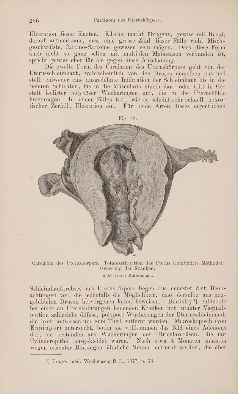 Ulceration dieser Knoten. Klebs macht übrigens, gewiss mit Recht, darauf aufmerksam, dass eine grosse Zahl dieser Fälle wohl Misch- geschwülste, Carcino-Sarcome gewesen sein mögen. Dass diese Form auch nicht so ganz selten mit multiplen Metastasen verbunden ist, spricht gewiss eher für als gegen diese Anschauung. Die zweite Form des Carcinoms des Uteruskörpers geht von der Uterusschleimhaut, wahrscheinlich von den Drüsen derselben aus und stellt entweder eine ausgedehnte Infiltration der Schleimhaut bis in die tieferen Schichten, bis in die Muscularis hinein dar, oder tritt in Ge- stalt isolirter polypöser Wucherungen auf, die in die Uterushöhle hineinragen. In beiden Fällen tritt, wie es scheint sehr schnell, nekro- tischer Zerfall, Ulceration en. Für beide Arten dieses eigentlichen T SS Sy. ' v ye HT, N Carcinom des Uteruskörpers. Totalexstirpation des Uterus (combinirte Methode). Genesung der Kranken. a Aeusserer Muttermund. Schleimhautkrebses des Uteruskörpers liegen aus neuester Zeit Beob- achtungen vor, die jedenfalls die Möglichkeit, dass derselbe aus neu- gebildeten Drüsen hervorgehen kann, beweisen. Breisky'!) entdeckte bei einer an Uterusblutungen leidenden Kranken mit intakter Vaginal- portion zahlreiche diffuse, polypöse Wucherungen der Uterusschleimhaut, die breit aufsassen und zum Theil entfernt wurden. Mikroskopisch (von Eppinger) untersucht, boten sie vollkommen das Bild eines Adenoms dar, sie bestanden aus Wucherungen der Utriculardrüsen, die mit Cylinderepithel ausgekleidet waren. Nach etwa 4 Monaten mussten wegen erneuter Blutungen ähnliche Massen entfernt werden, die aber I) Prager med. Wochenschrift I, 1877, p. 78.