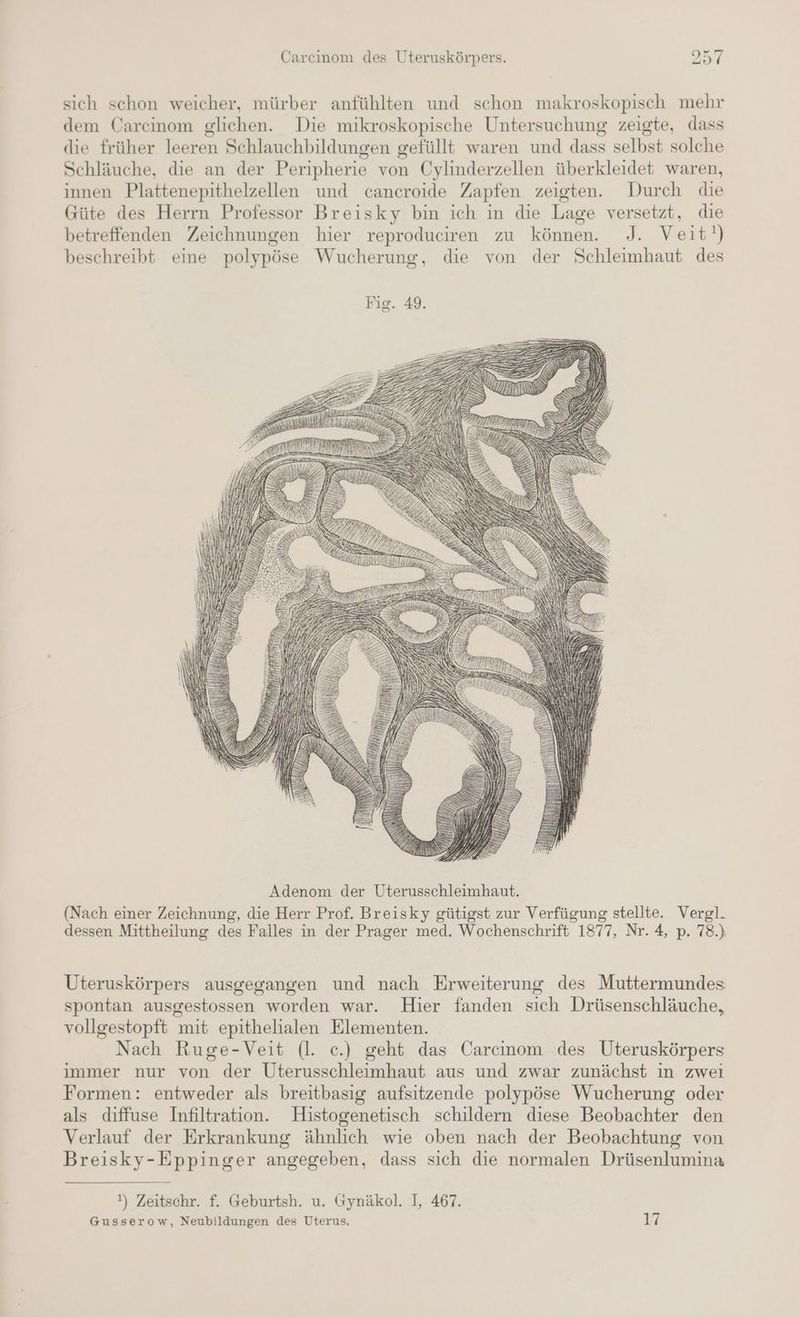 sich schon weicher, mürber anfühlten und schon makroskopisch mehr dem Carcinom glichen. Die mikroskopische Untersuchung zeigte, dass die früher leeren Schlauchbildungen gefüllt waren und dass selbst solche Schläuche, die an der Peripherie von Cylinderzellen überkleidet waren, innen Plattenepithelzellen und cancroide Zapfen zeigten. Durch die Güte des Herrn Professor Breisky bin ich in die Lage versetzt, die betreffenden Zeichnungen hier reproduciren zu können. J. Veit!) beschreibt eime polypöse Wucherung, die von der Schleimhaut des (Nach einer Zeichnung, die Herr Prof. Breisky gütigst zur Verfügung stellte. Vergl. dessen Mittheilung des Falles in der Prager med. Wochenschrift 1877, Nr. 4, p. 78.) Uteruskörpers ausgegangen und nach Erweiterung des Muttermundes spontan ausgestossen worden war. Hier fanden sich Drüsenschläuche, vollgestopft mit epithelialen Elementen. Nach Ruge-Veit (l. c.) geht das Carcinom des Uteruskörpers immer nur von der Uterusschleimhaut aus und zwar zunächst in zwei Formen: entweder als breitbasig aufsitzende polypöse Wucherung oder als diffuse Infiltration. Histogenetisch schildern diese Beobachter den Verlauf der Erkrankung ähnlich wie oben nach der Beobachtung von Breisky-Eppinger angegeben, dass sich die normalen Drüsenlumina !) Zeitschr. f. Geburtsh. u. Gynäkol. I, 467. Gusserow, Neubildungen des Uterus. 12