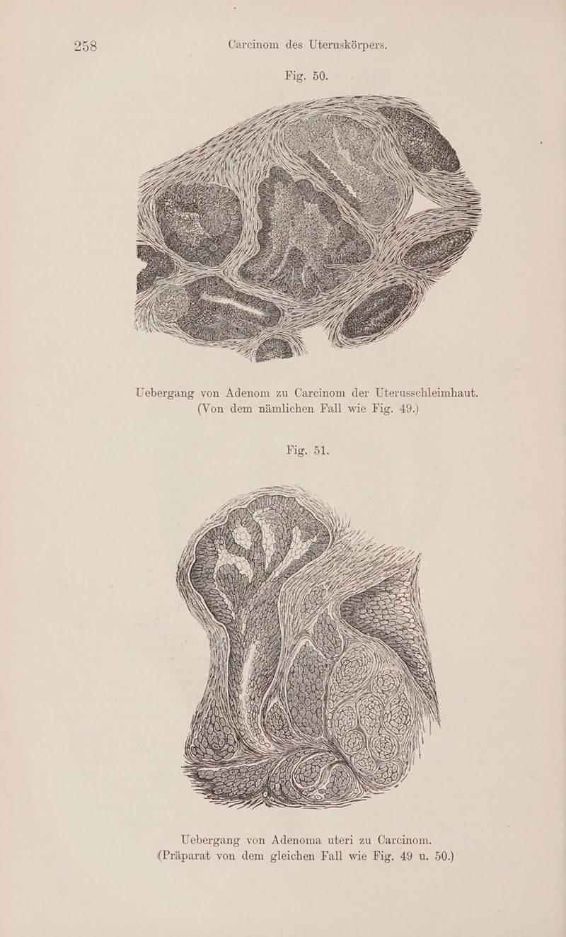 Uebergang von Adenom zu Carcinom der Uterusschleimhaut. (Von dem nämlichen Fall wie Fig. 49.) EZ DELL Zt Uebergang von Adenoma uteri zu Carcinom. (Präparat von dem gleichen Fall wie Fig. 49 u. 50.)