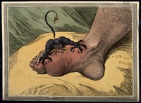 view A swollen and inflamed foot: gout is represented by an attacking demon. Coloured soft-ground etching by J. Gillray, 1799.