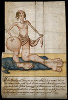 view A woman with scales on her upper body and grossly enlarged lower limbs. Watercolour, 1695.